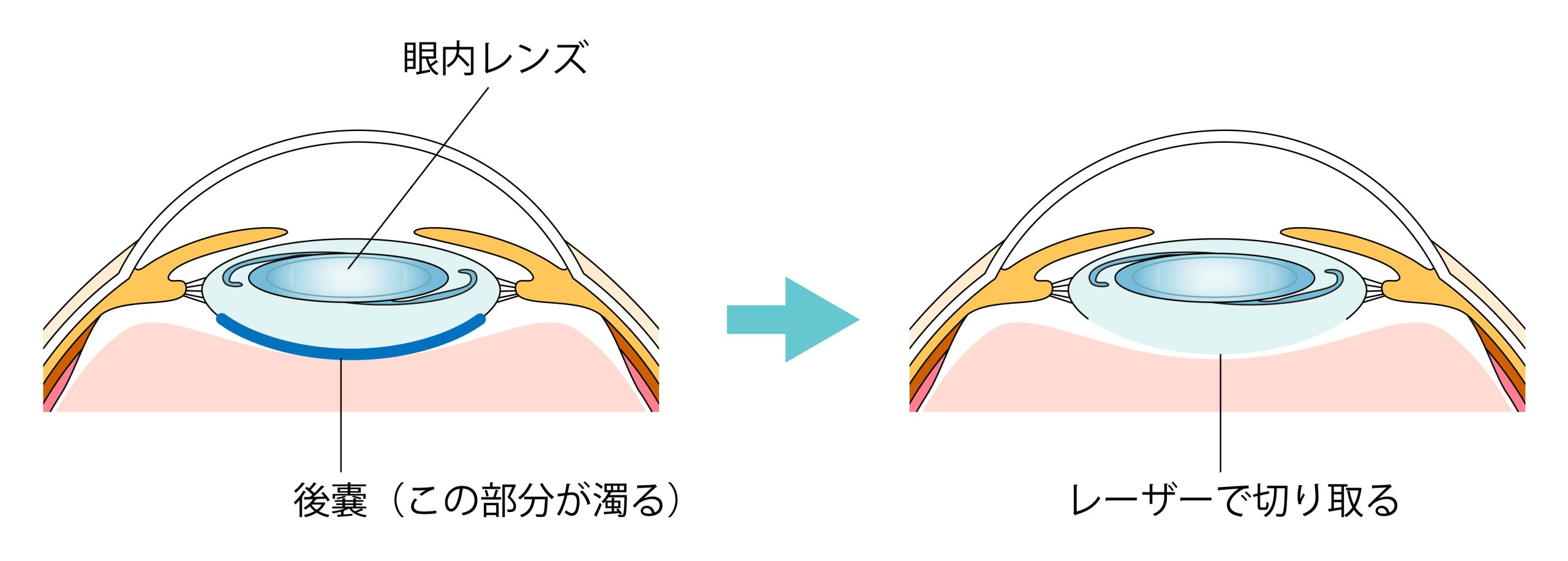 白内障手術後の再発？後発白内障の正体とレーザー治療・費用を徹底解説