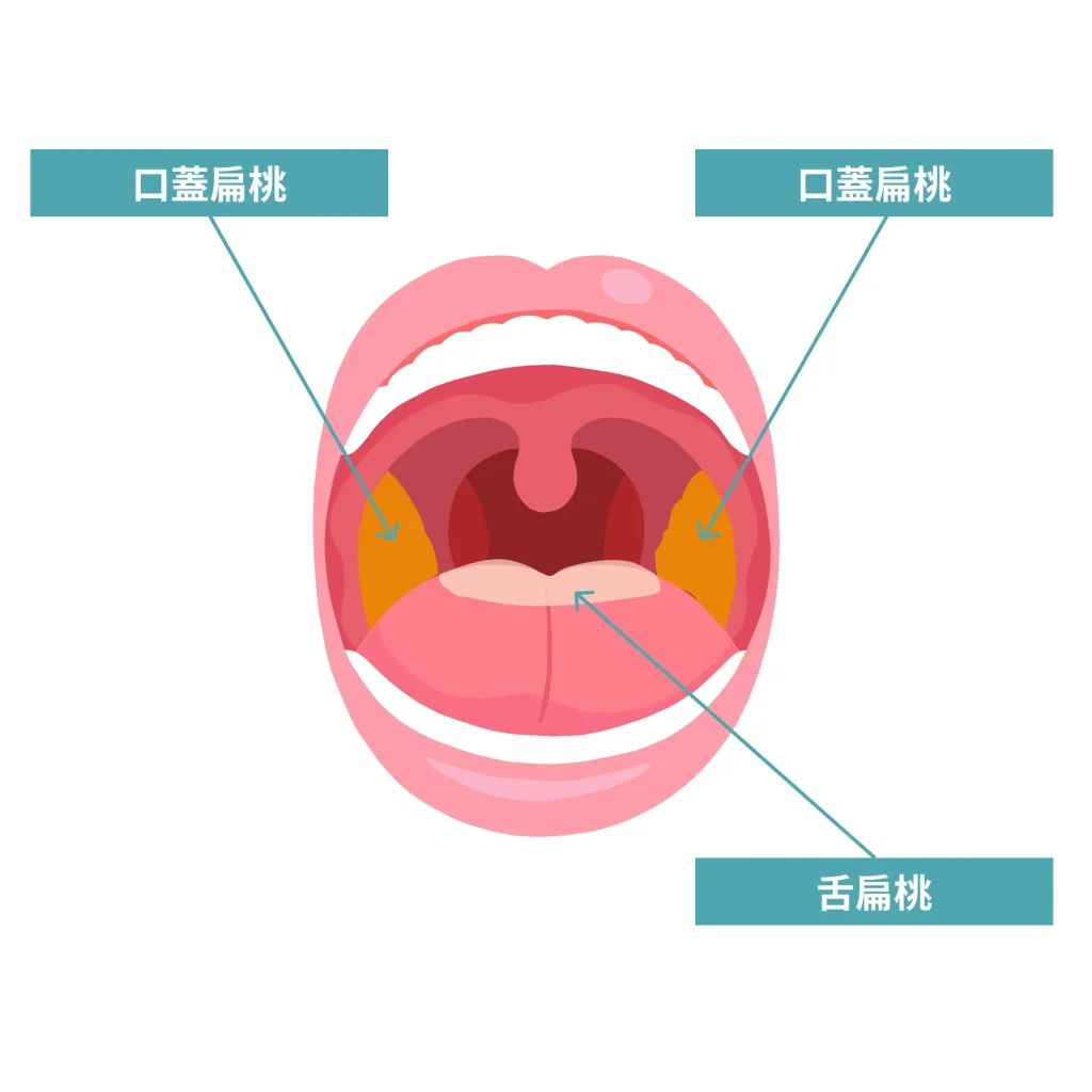 激しいいびきは扁桃腺肥大が原因？手術費用と放置の危険リスクを徹底検証