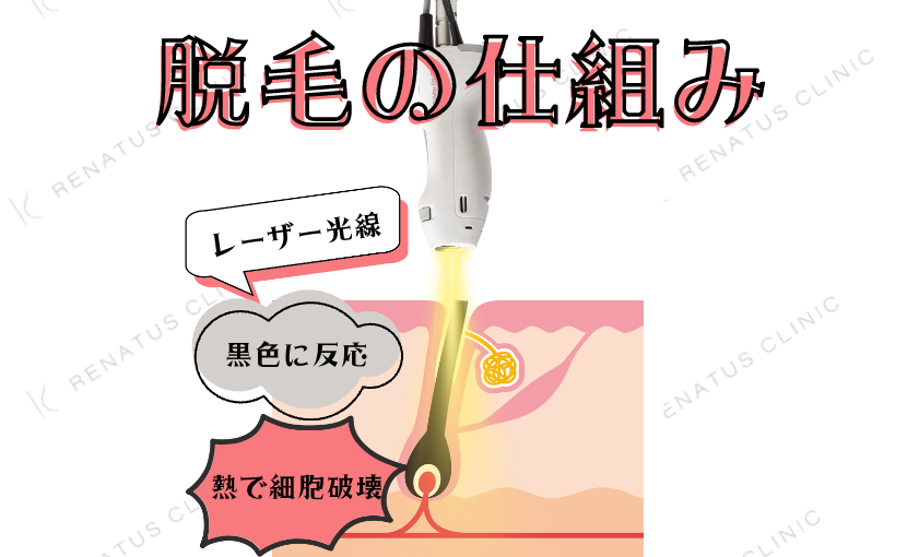 Vio脱毛は黒ずみがあっても照射できる？悪化の真相と改善法を徹底解説