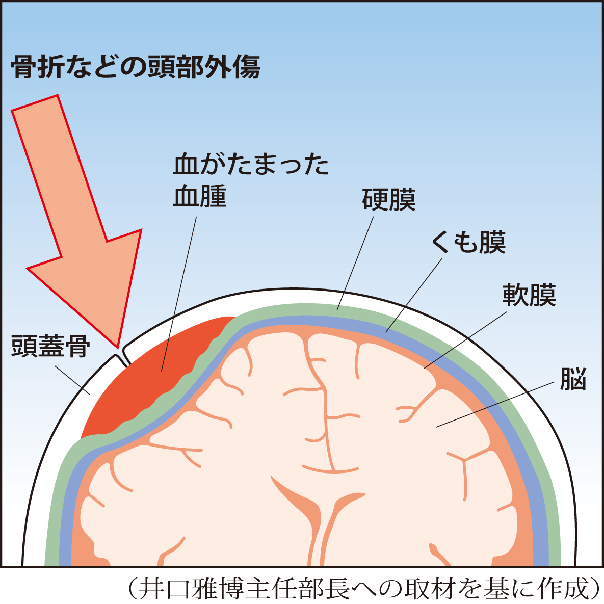 硬膜外血腫はなぜ起こるのか、知っておくべき決定的な理由とは？初期症状や予後、後遺症リスクまで最新情報をわかりやすく解説します。