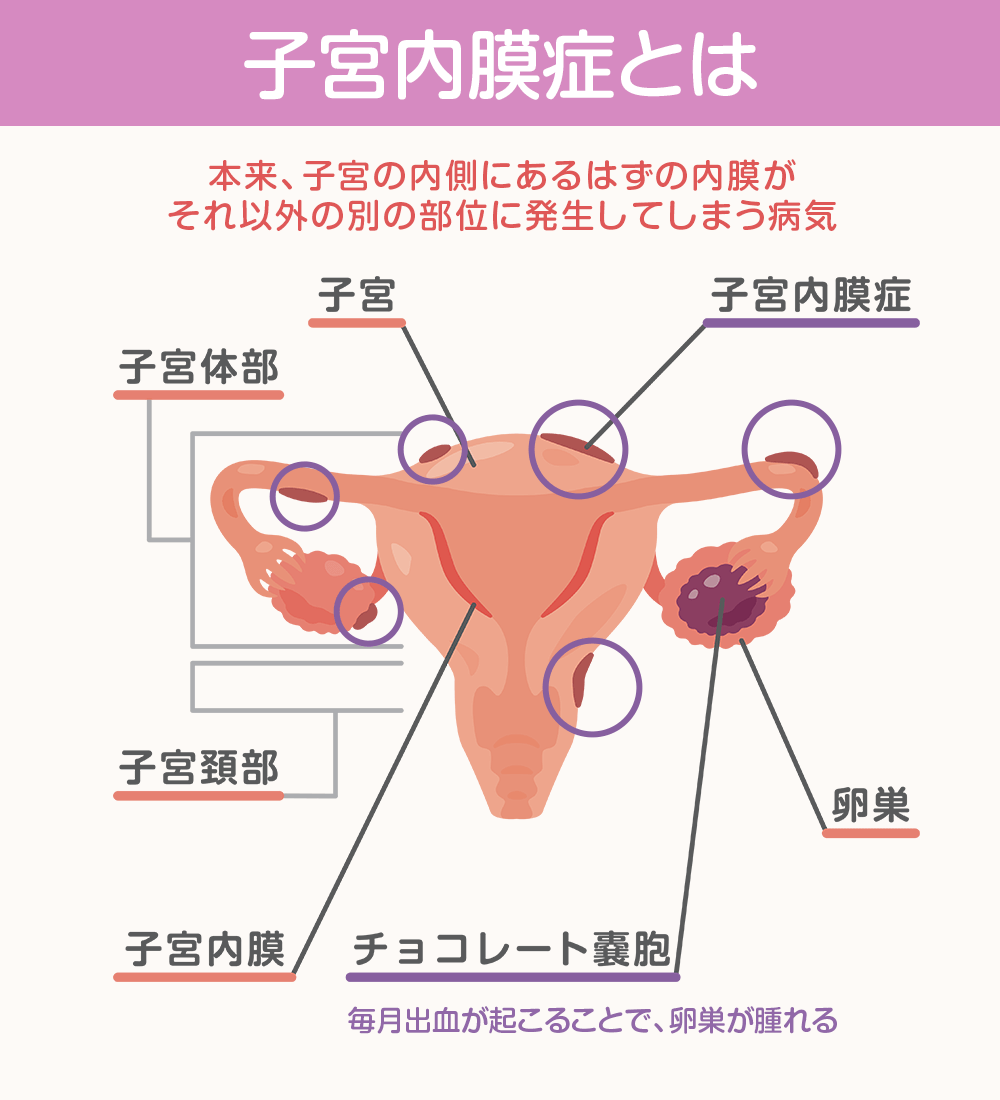 子宮内膜症の検査、痛みと費用の全真相【2026年最新】知らないと後悔する受診ガイド