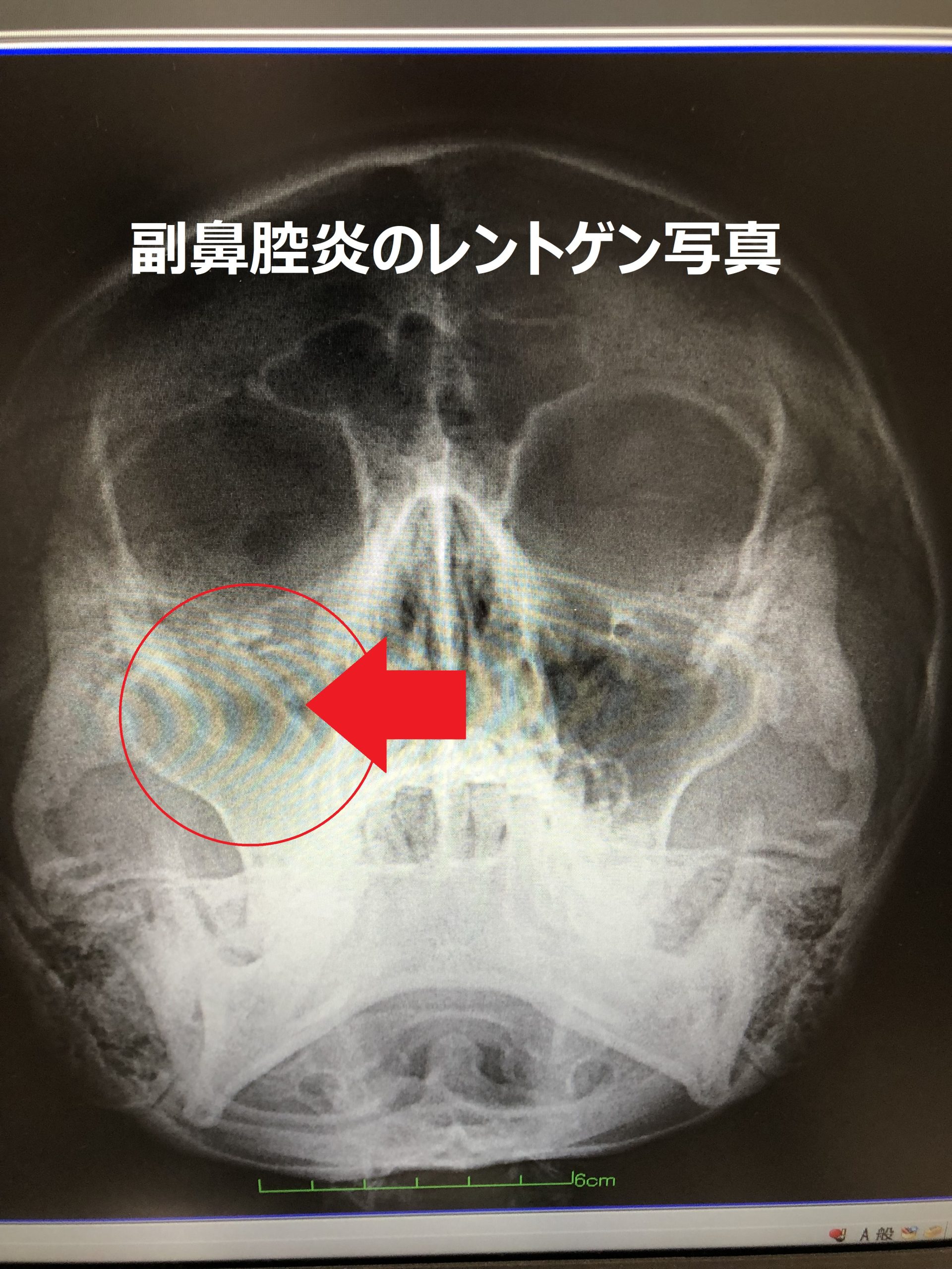 【蓄膿症の鼻水の色】画像で見る危険サイン一覧