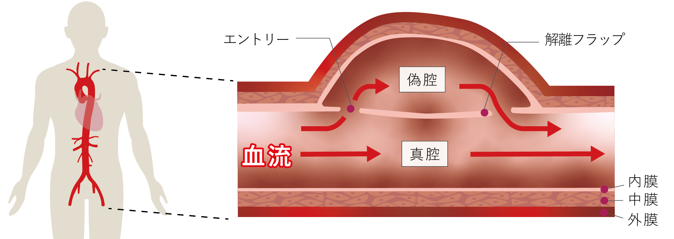 急性大動脈解離は突然死を招く危険な病気。一体どんな前兆や症状があるのか？発症の原因から生存率、治療法まで生死を分ける決定的な情報を今すぐ解説。