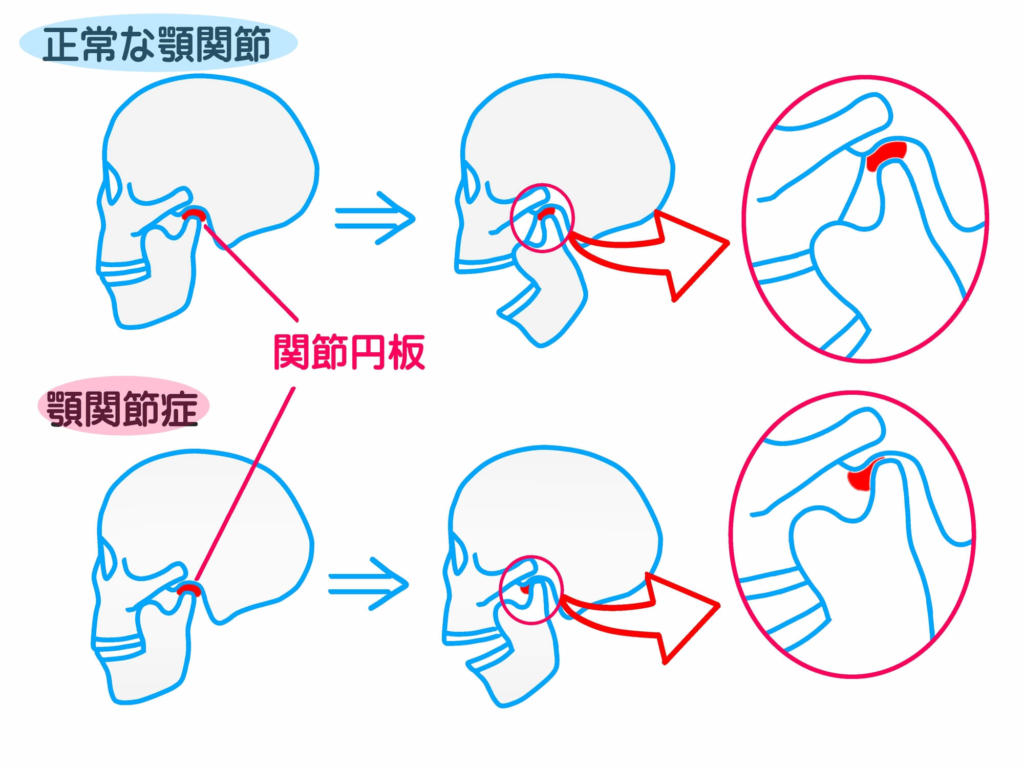 口を開けると痛い原因は？顎関節症・親知らずの見極めと受診科の全基準