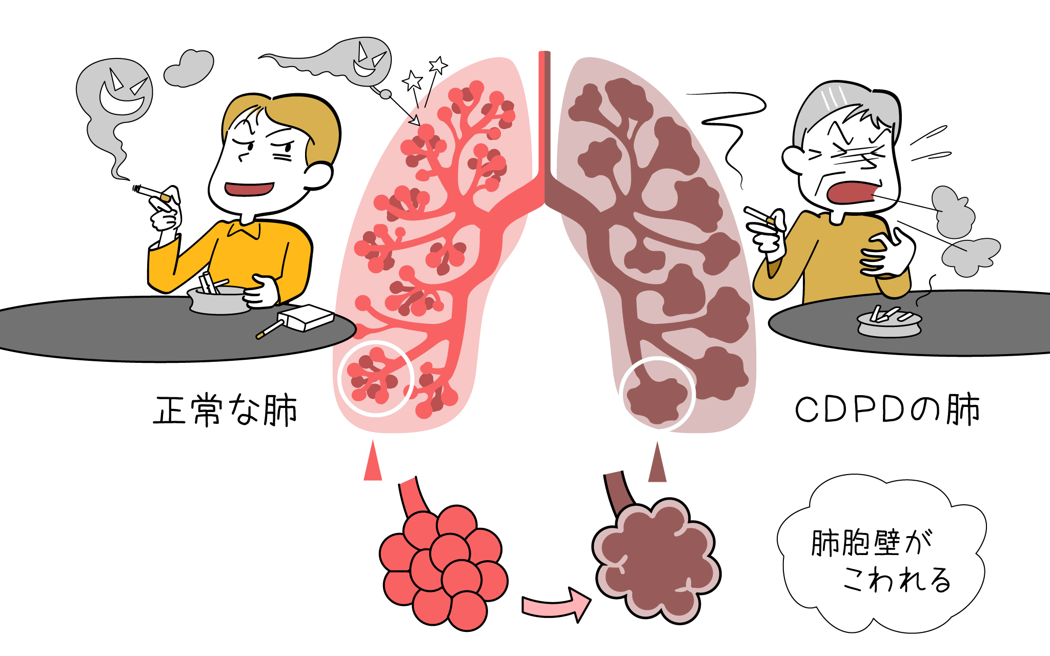 【肺気腫は治るのか】“治った”体験談の真相と現代医療の限界、回復への現実的戦略