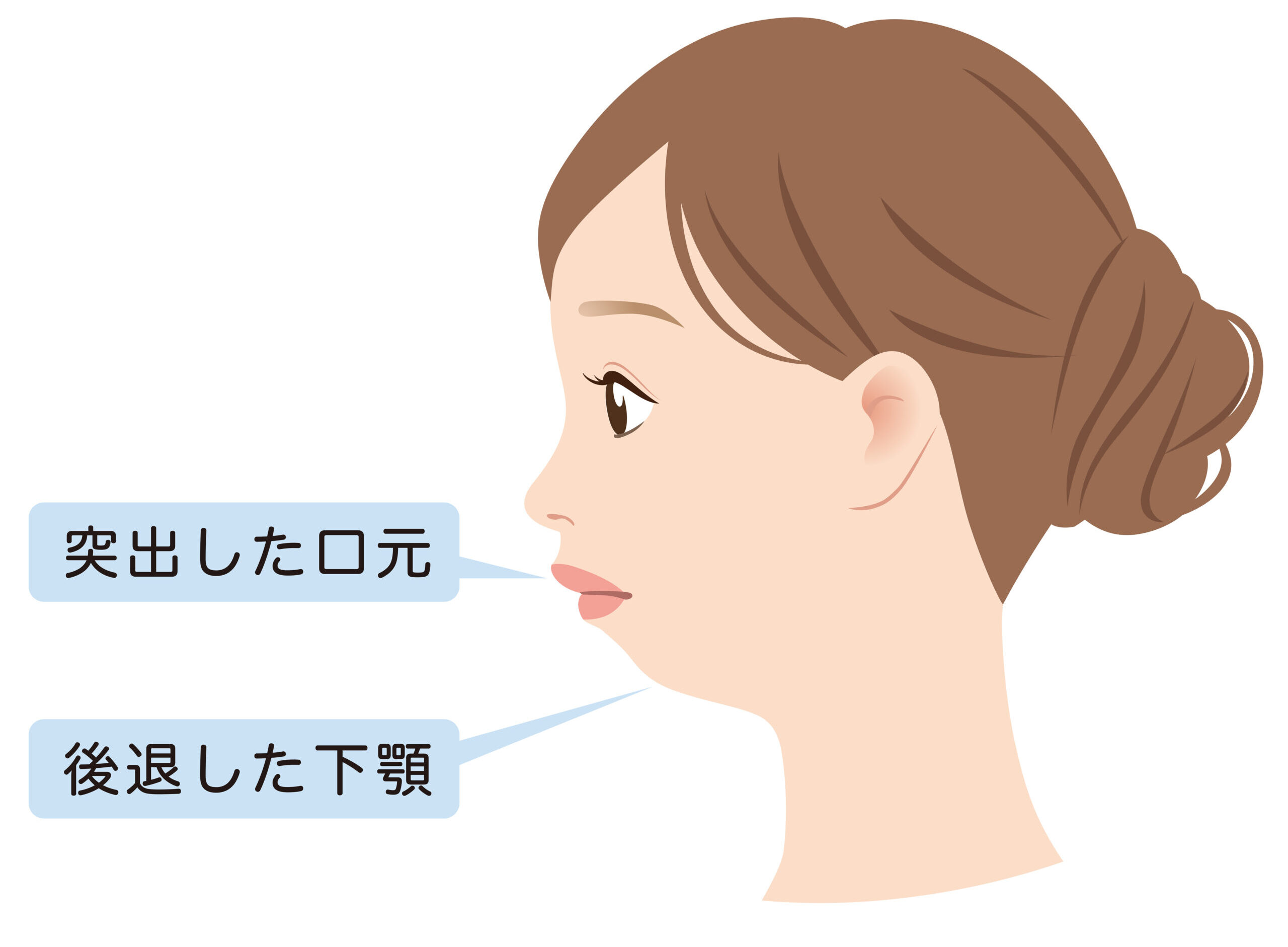 顎が小さい原因と二重顎・無呼吸の真相｜Eライン改善と最新治療法
