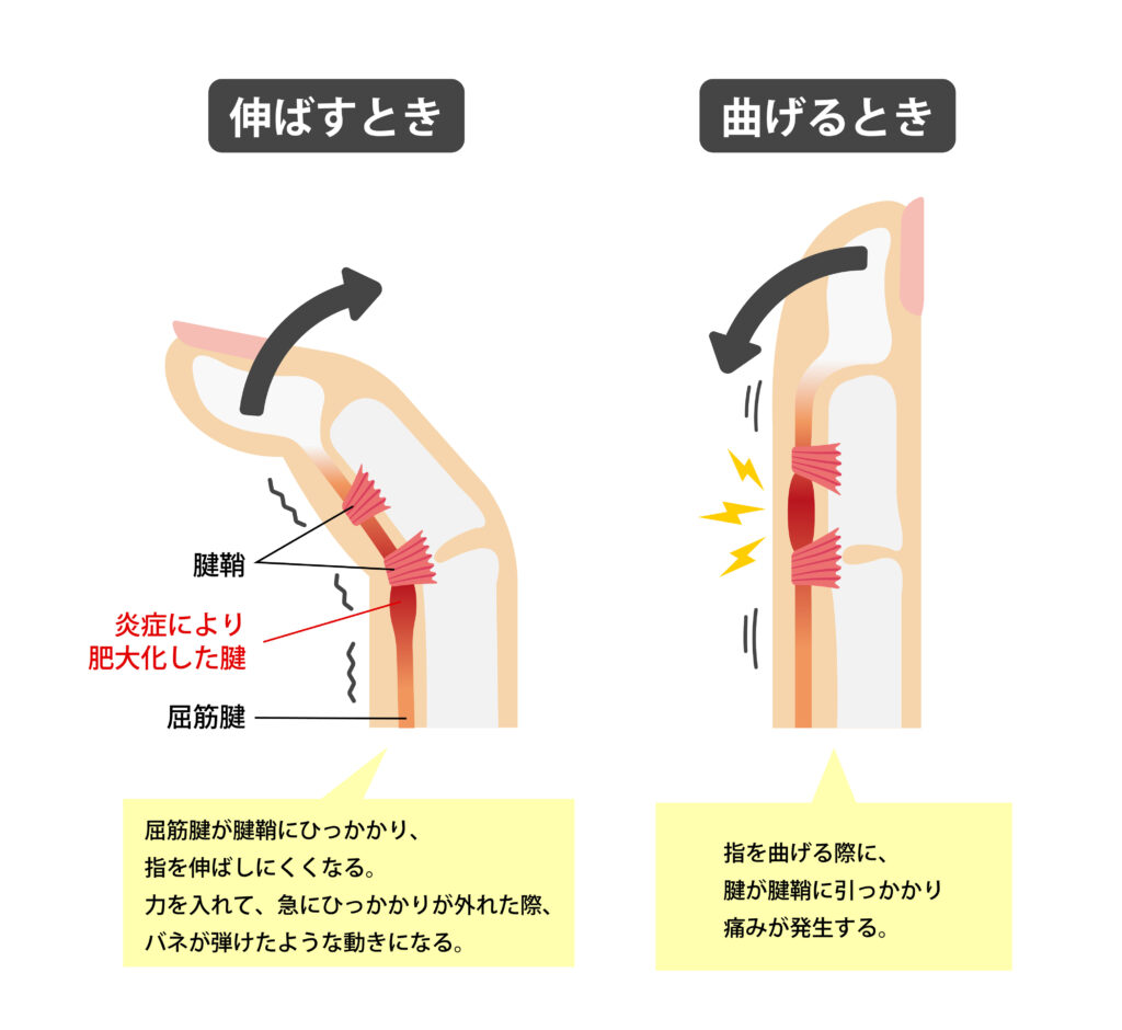 なぜ糖尿病でばね指が多発する原因とは？高血糖の罠と治らない時の治療法