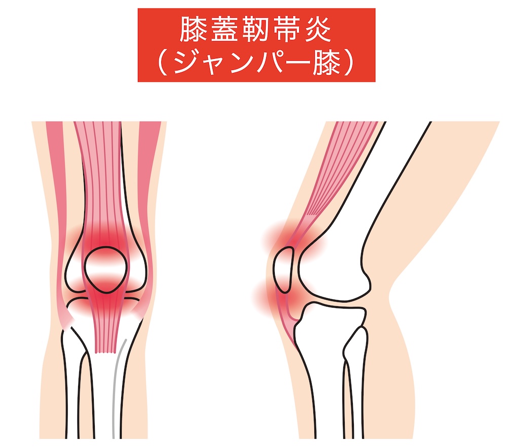 【2026年最新】ジャンパー膝とは？放置すると危険な症状と正しい治し方