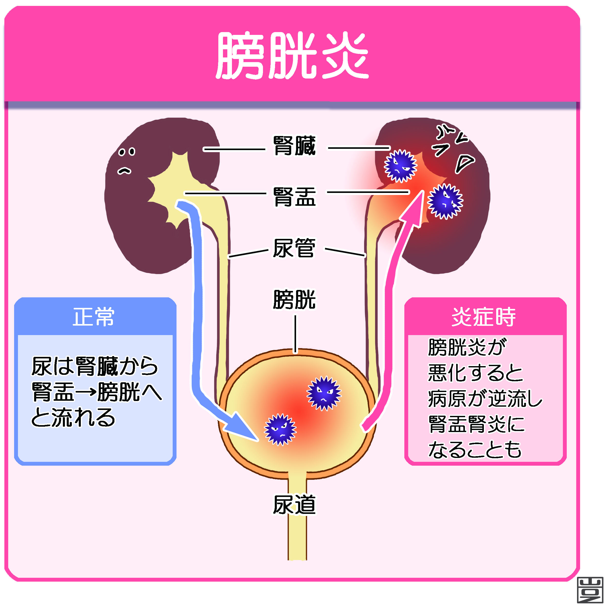 膀胱炎で血尿が出たとき、多くの人が「ついに腎臓まで悪くなったのでは」と不安を募らせる。だが、膀胱炎に伴う血尿の多くは適切に対処すれば治るものだ。一方で、痛みがない血尿こそ膀胱がんなど別の病気のサインである可能性があり、軽視できない。本記事では、女性・男性別の原因、受診の目安、2026年時点での治療と再発防止策まで、編集部が独自に集めた臨床データと患者の声を交えて詳しく解説する。