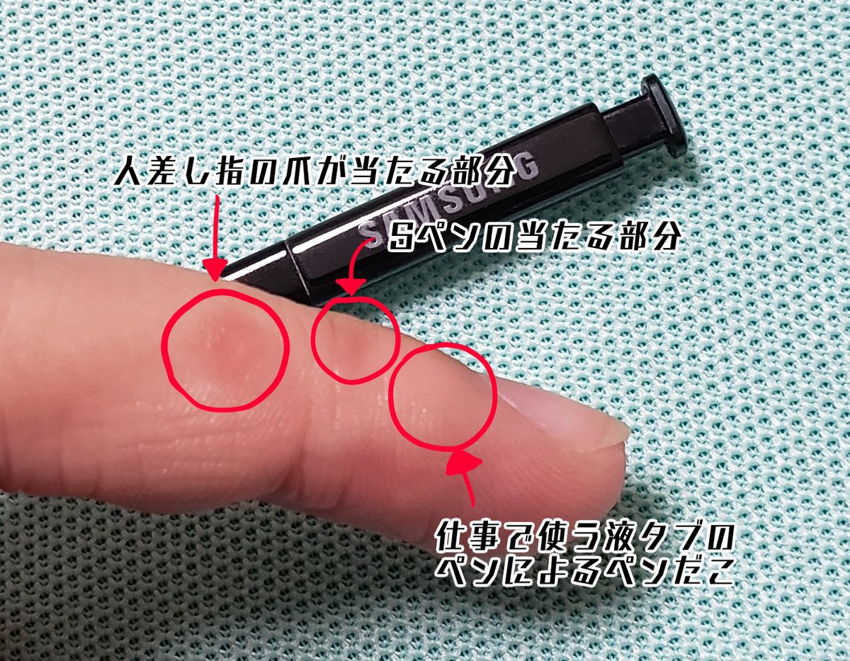 人差し指のペンだこが痛い！原因別の治し方と再発を防ぐ持ち方改善術