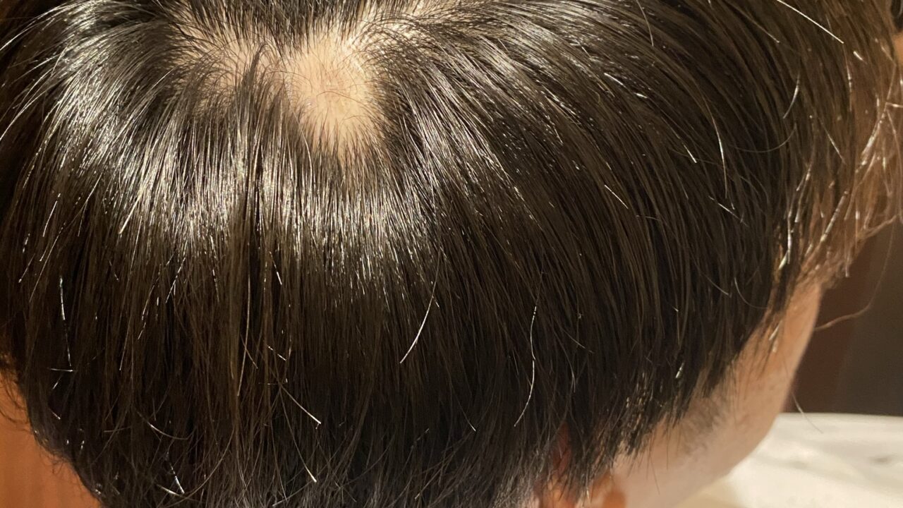 【2026年最新】「頭皮のかさぶた剥がし」なぜやめられない？Snsで急増する中毒者の心理と皮膚科医が教える恐ろしい代償