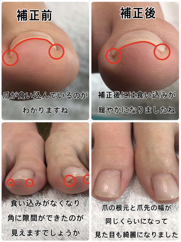 爪が食い込む激痛の対処法！深爪の罠と自宅ケア・受診目安を徹底解説