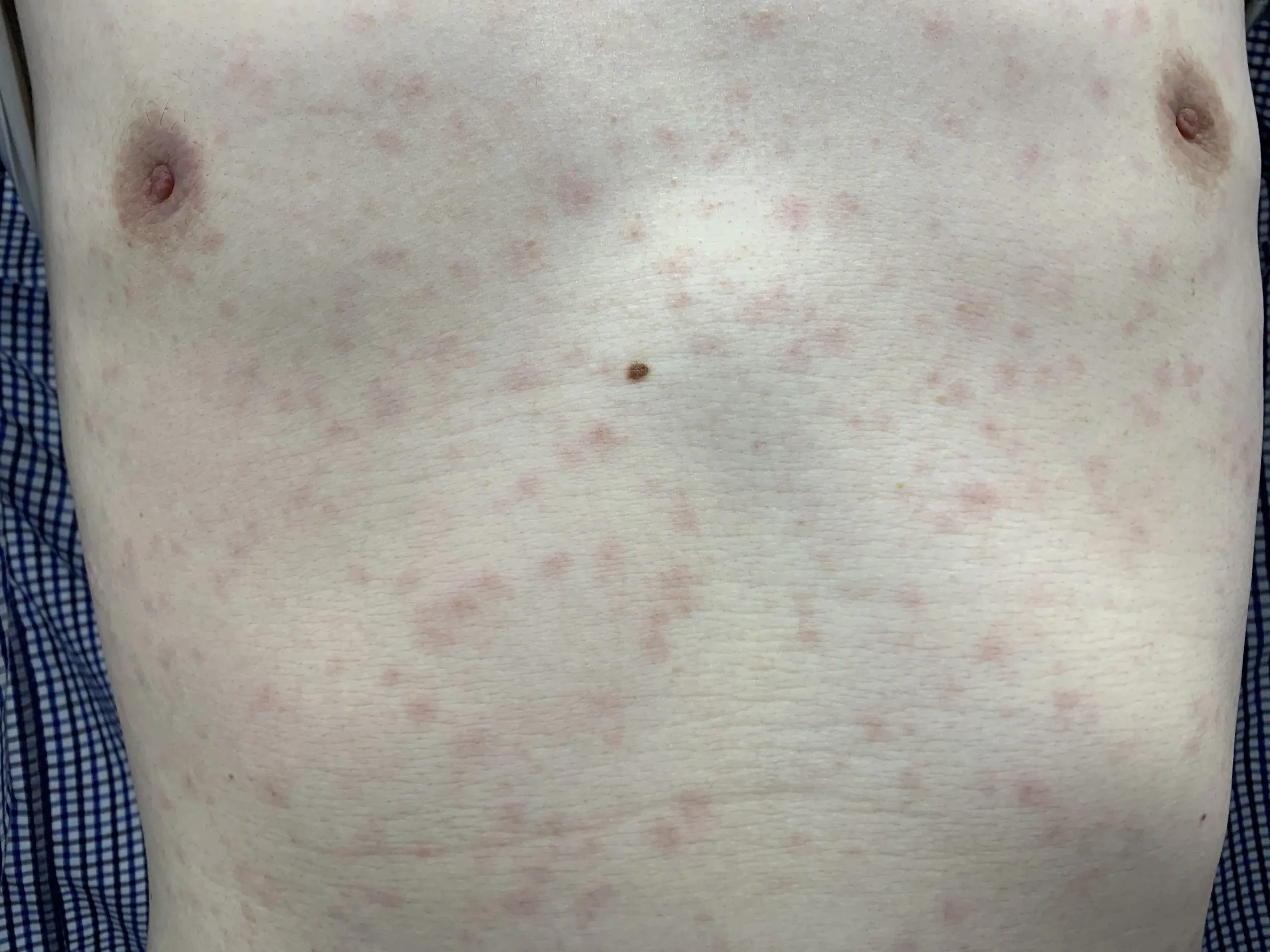 梅毒の皮膚症状を見逃すな！手のひらの斑点やしこりの特徴と見分け方