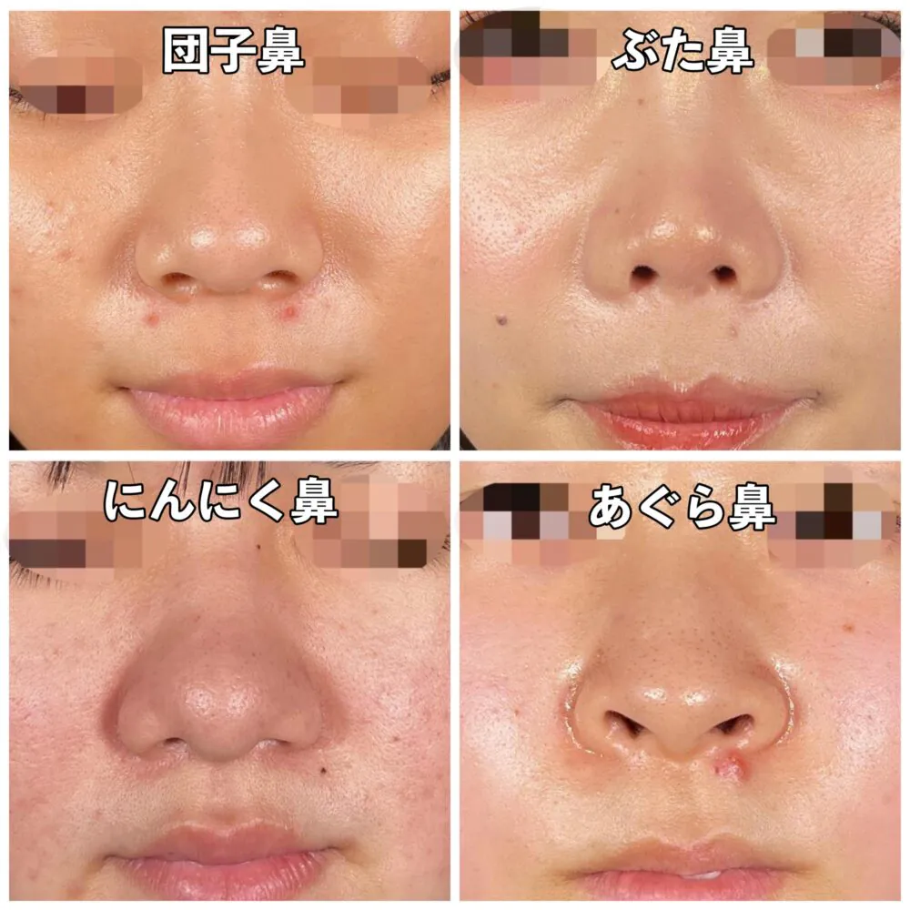 鼻の形診断で運命と印象が変わる！タイプ別特徴と2026年最新美鼻術