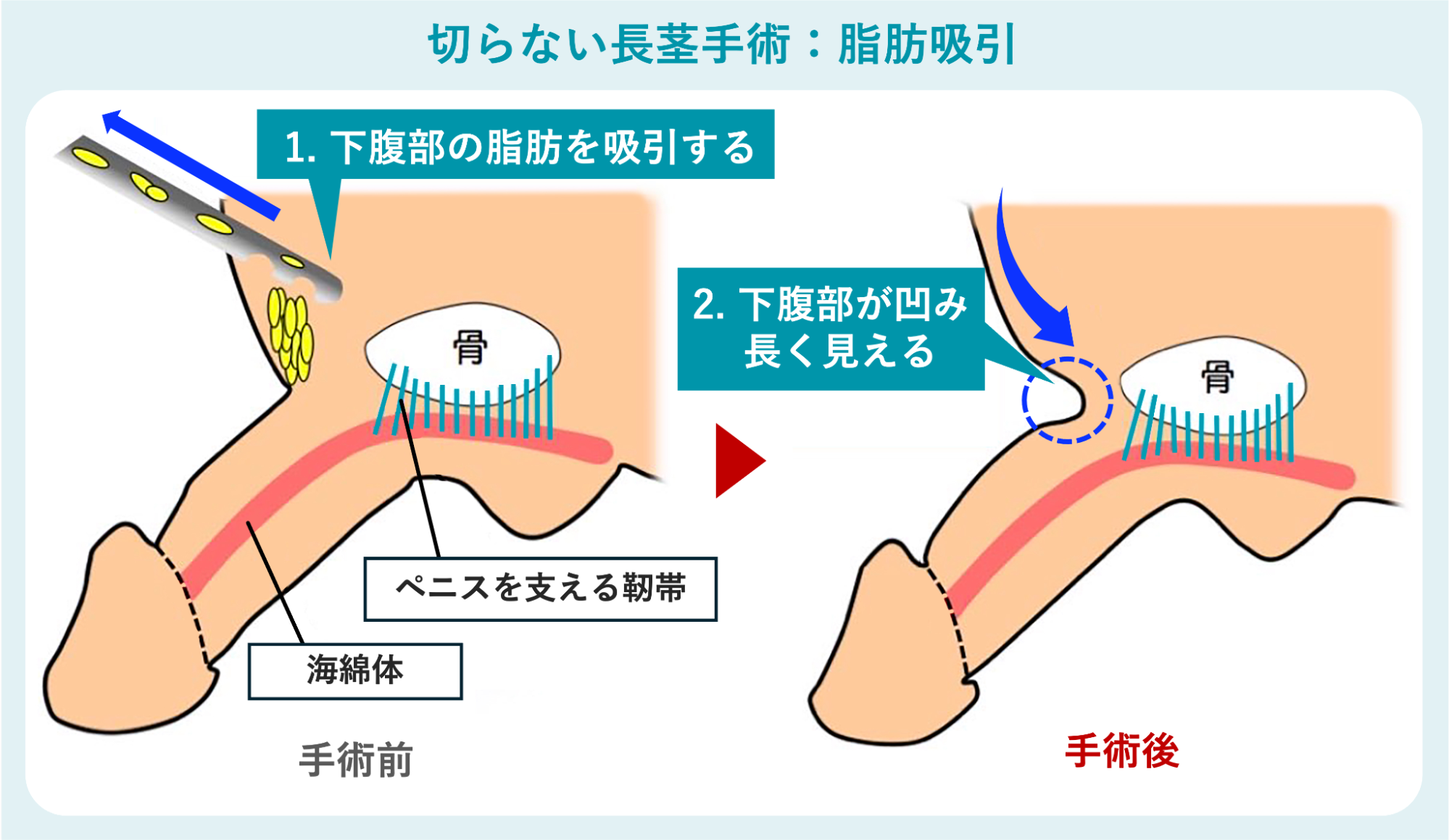 切らない長茎術の真実｜2026年最新リスク・費用・体験談を徹底検証