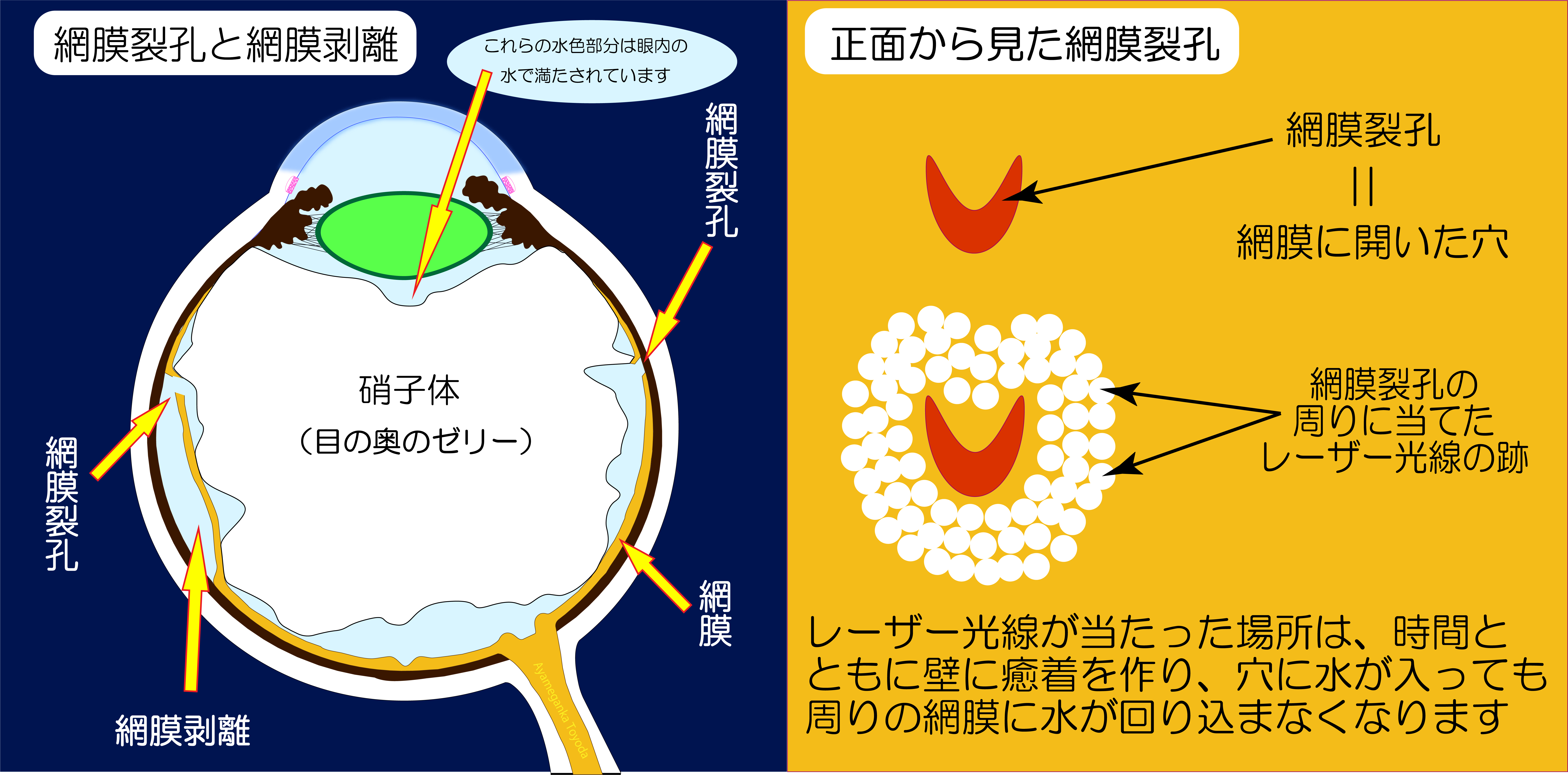 網膜光凝固術の手術は痛い？失明防ぐ効果・費用相場と術後のリアル