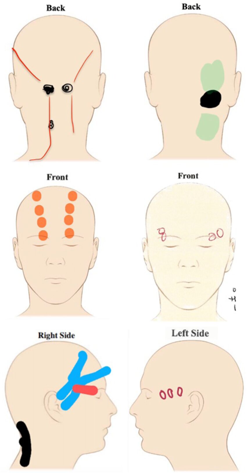 頭頂部のしこりを押すと痛い…受診すべき診療科と危険サイン【2026年最新】