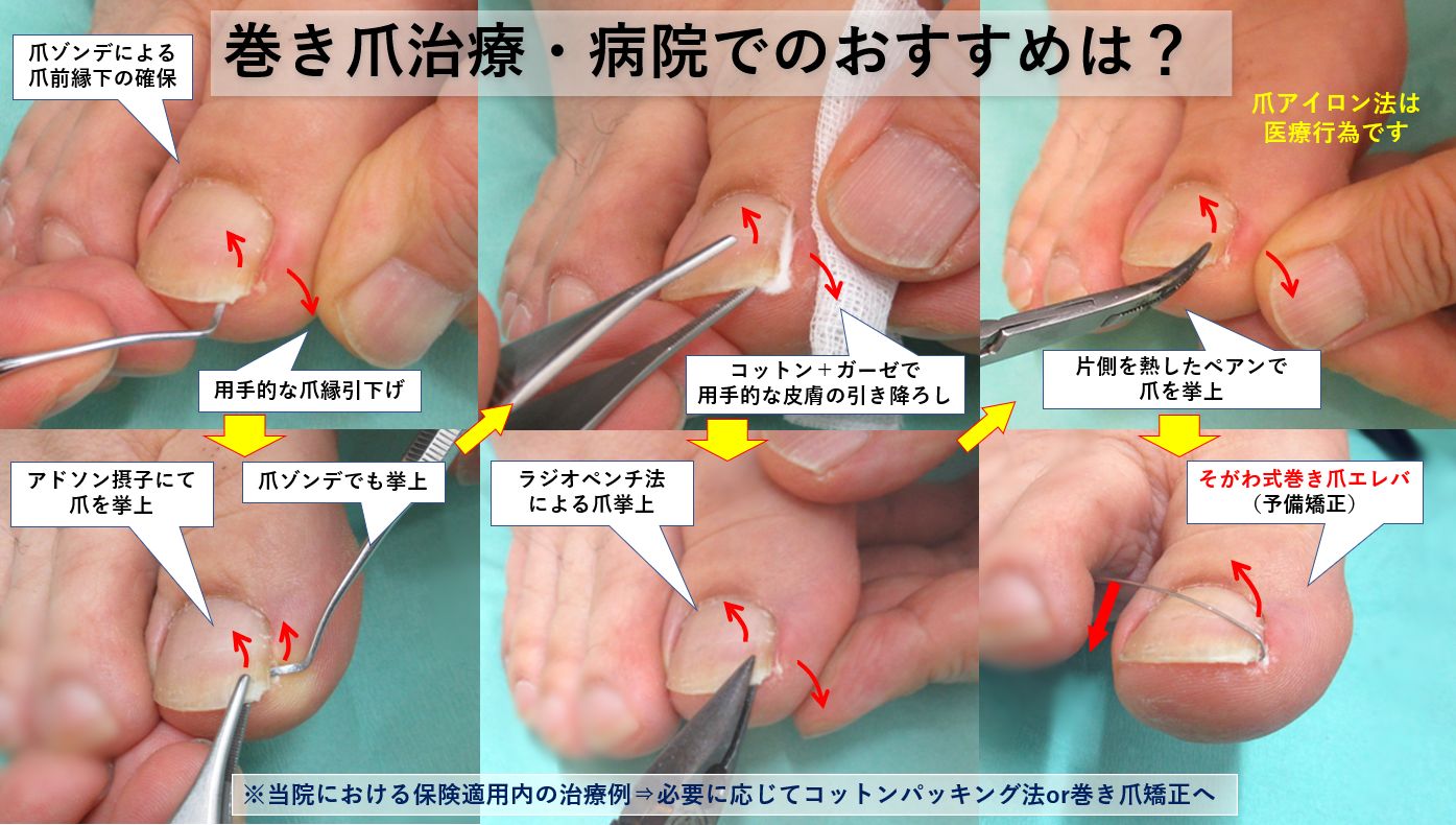 巻き爪治療は激痛？保険適用の違いと切らない最新治し方2026