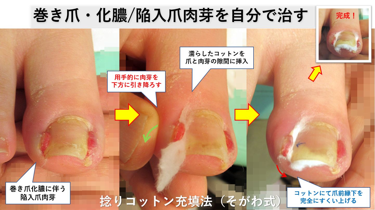 巻き爪の肉芽は自分で治せる？激痛の原因と皮膚科治療の全貌