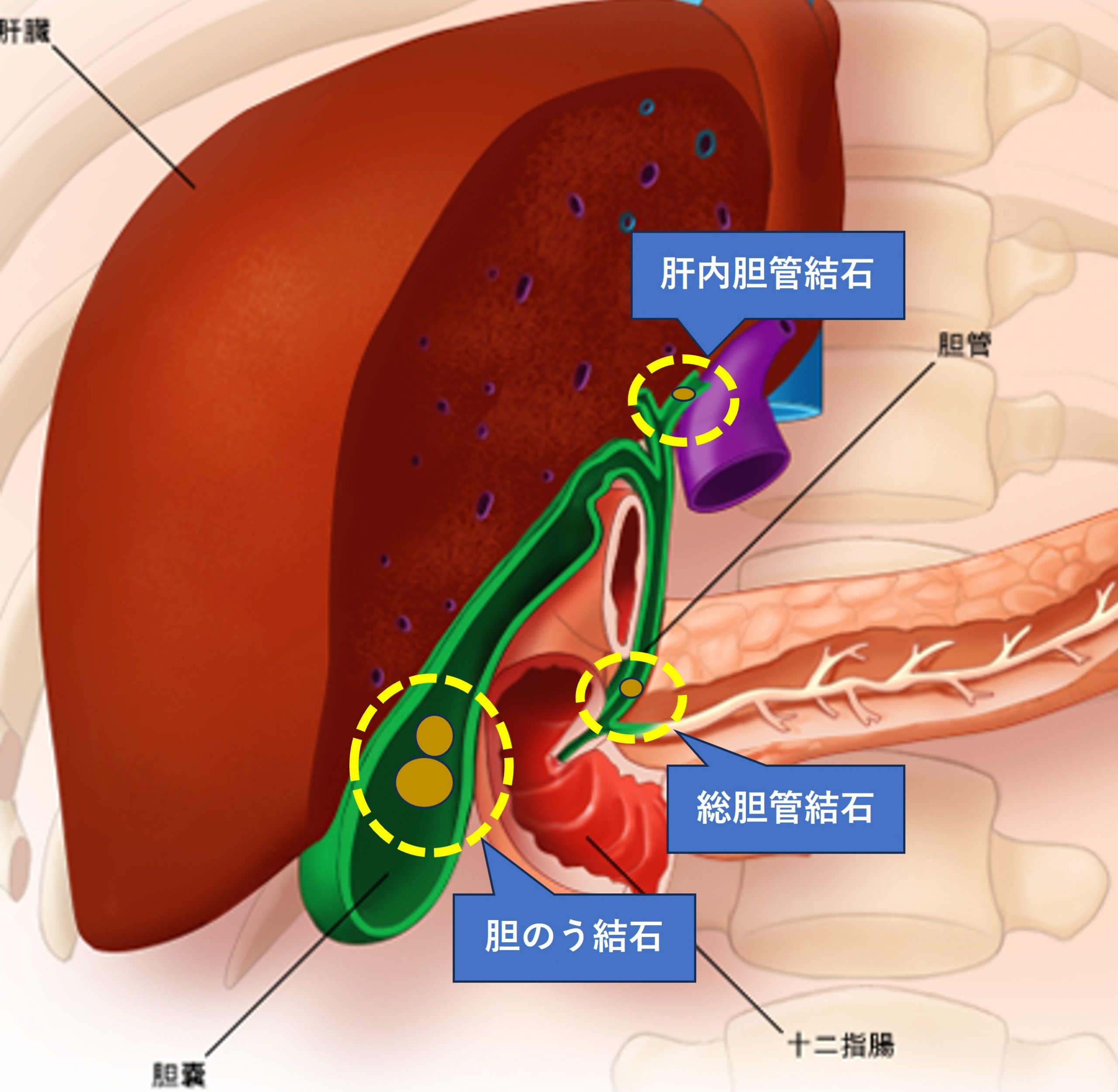 胆嚢結石の原因と食生活の罠｜背中の激痛を防ぐ最新治療と予防策2026