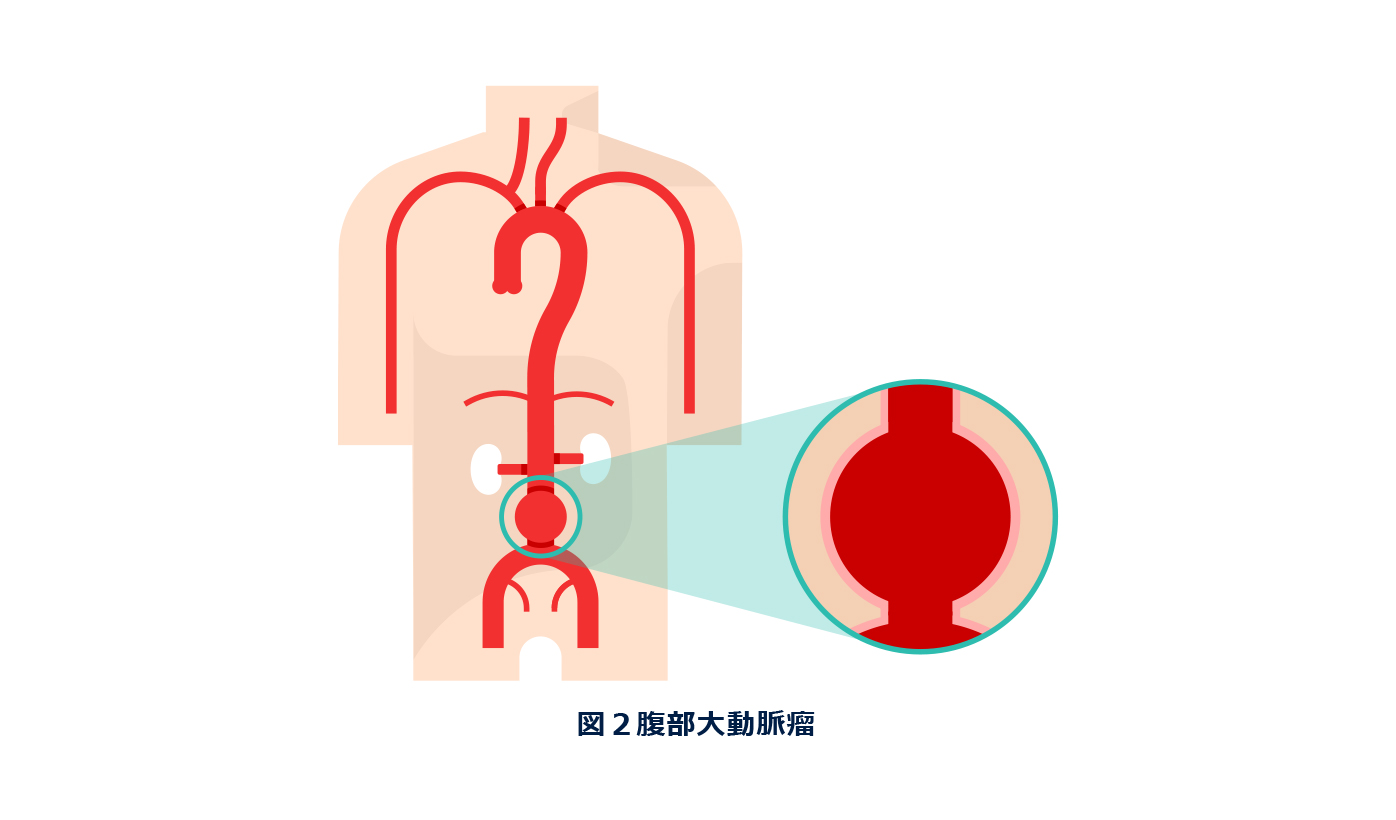 お腹の脈打つしこりは破裂の前兆か？腹部動脈瘤の初期症状と手術基準