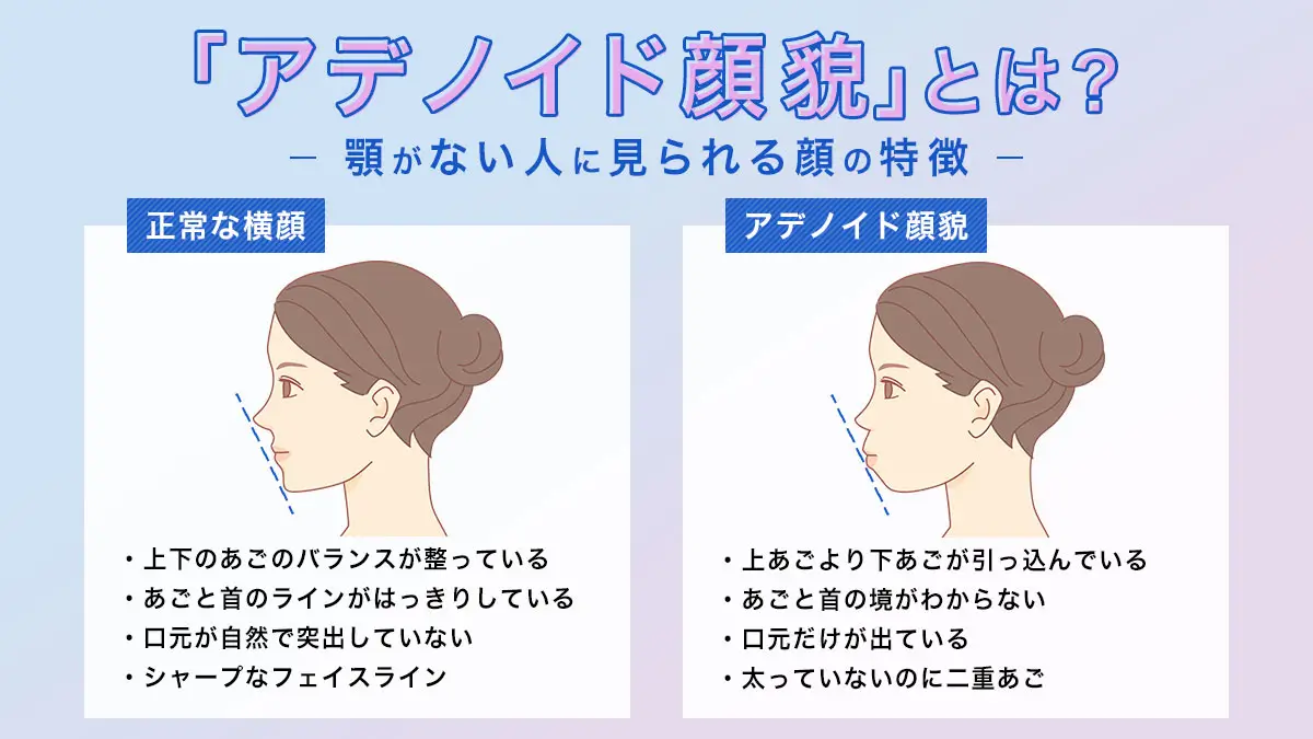 「顎がない」悩みの正体は？アデノイド顔貌とEラインの最新治療法