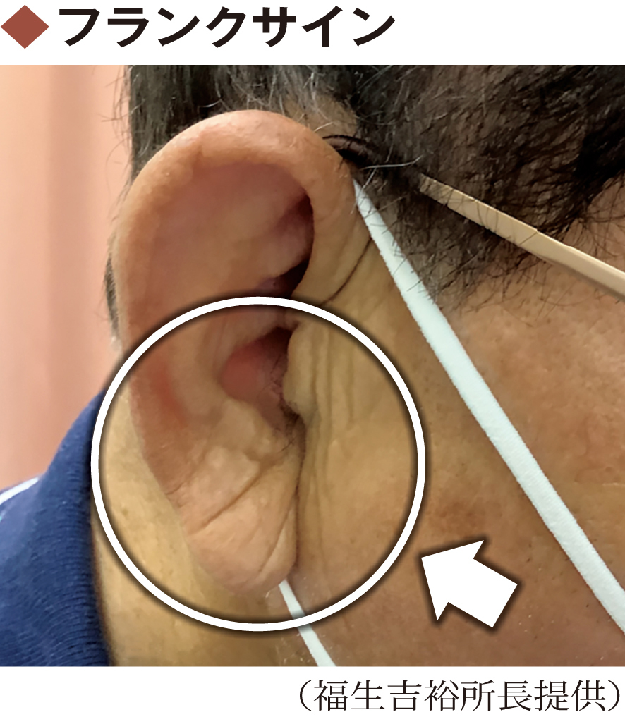 耳たぶのシワは動脈硬化の予兆？フランク徴候の見分け方と受診目安