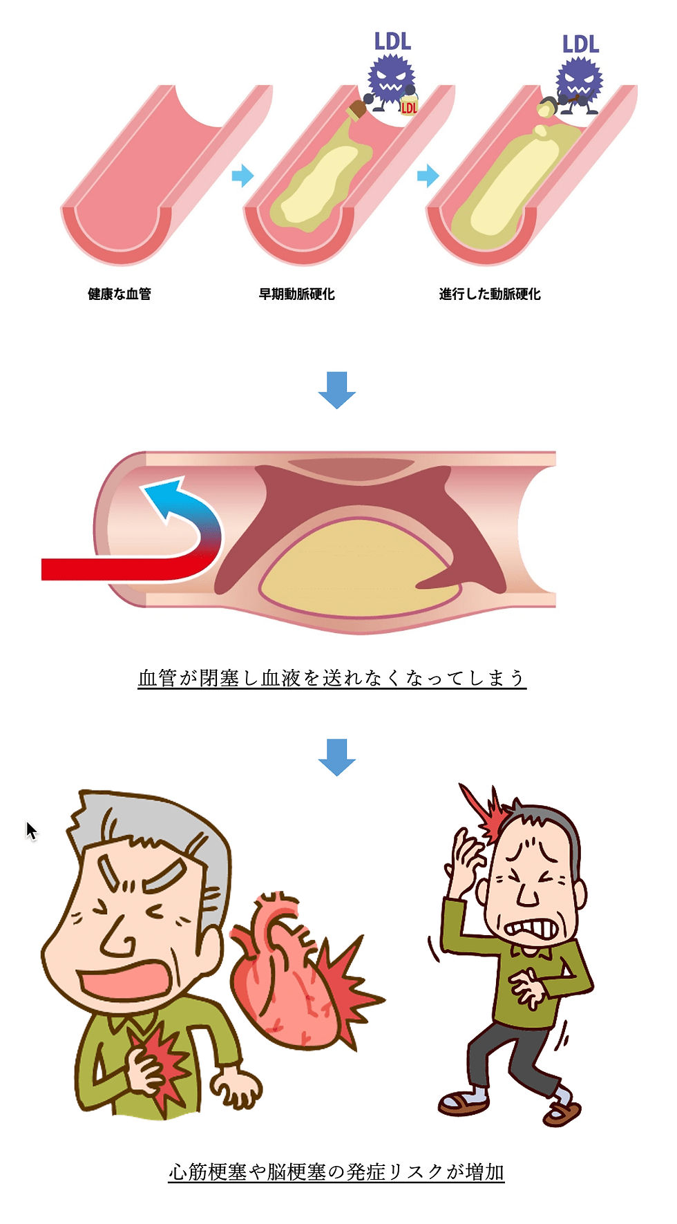 脳梗塞とコレステロールの新常識！下げすぎは危険？命を守る最新予防法