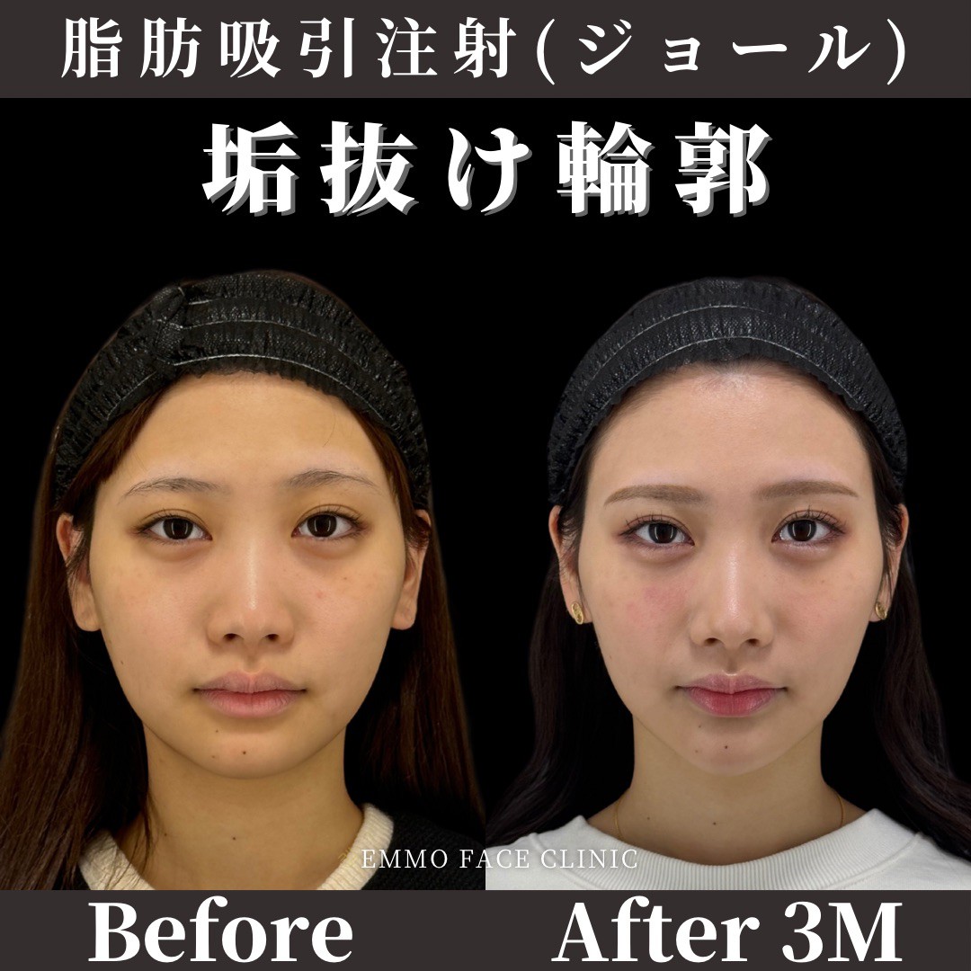 顔の肉、本当に落とせますか？2026年最新版｜「落ちない理由」と今すぐ効く3つの鉄則