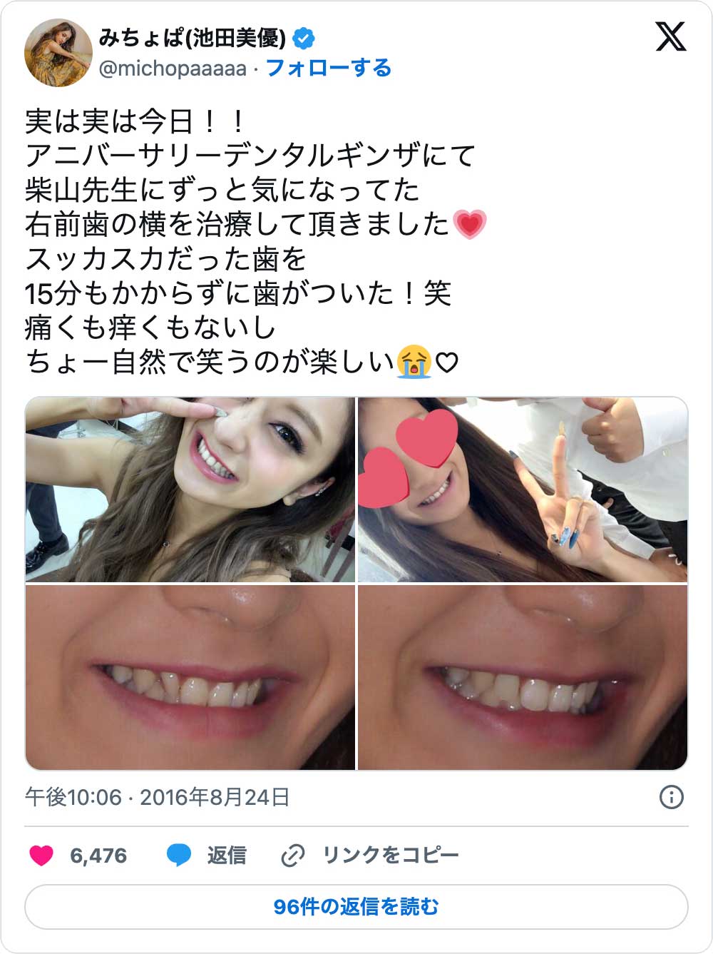 芸能人の歯が白すぎる真相｜オールセラミックの失敗と後悔を徹底検証