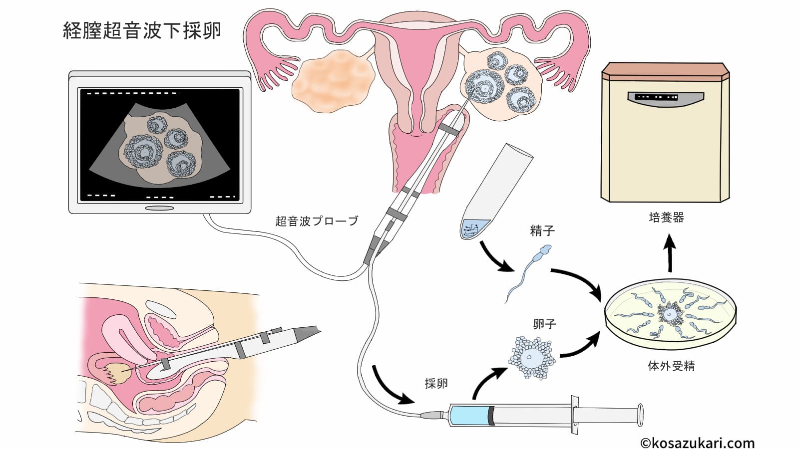 人工授精で女の子は産み分け可能？成功確率と噂の真相を徹底解説