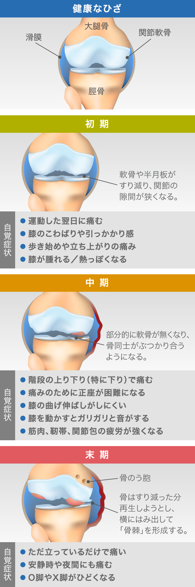 膝軟骨のすり減りは再生する？放置の危険と2026年最新治療の真相