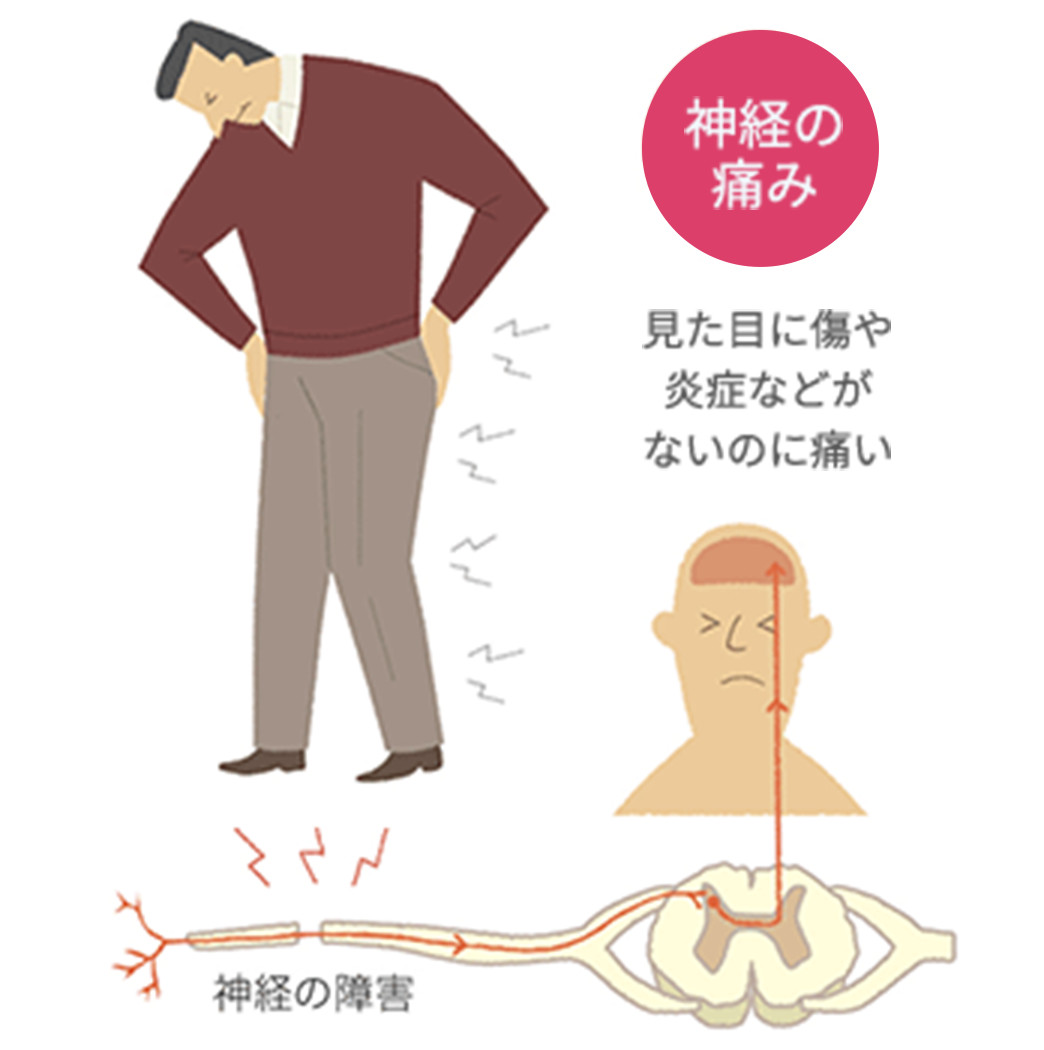 神経障害性疼痛の正体｜なぜ長引く？放置の危険性と2026年最新治療