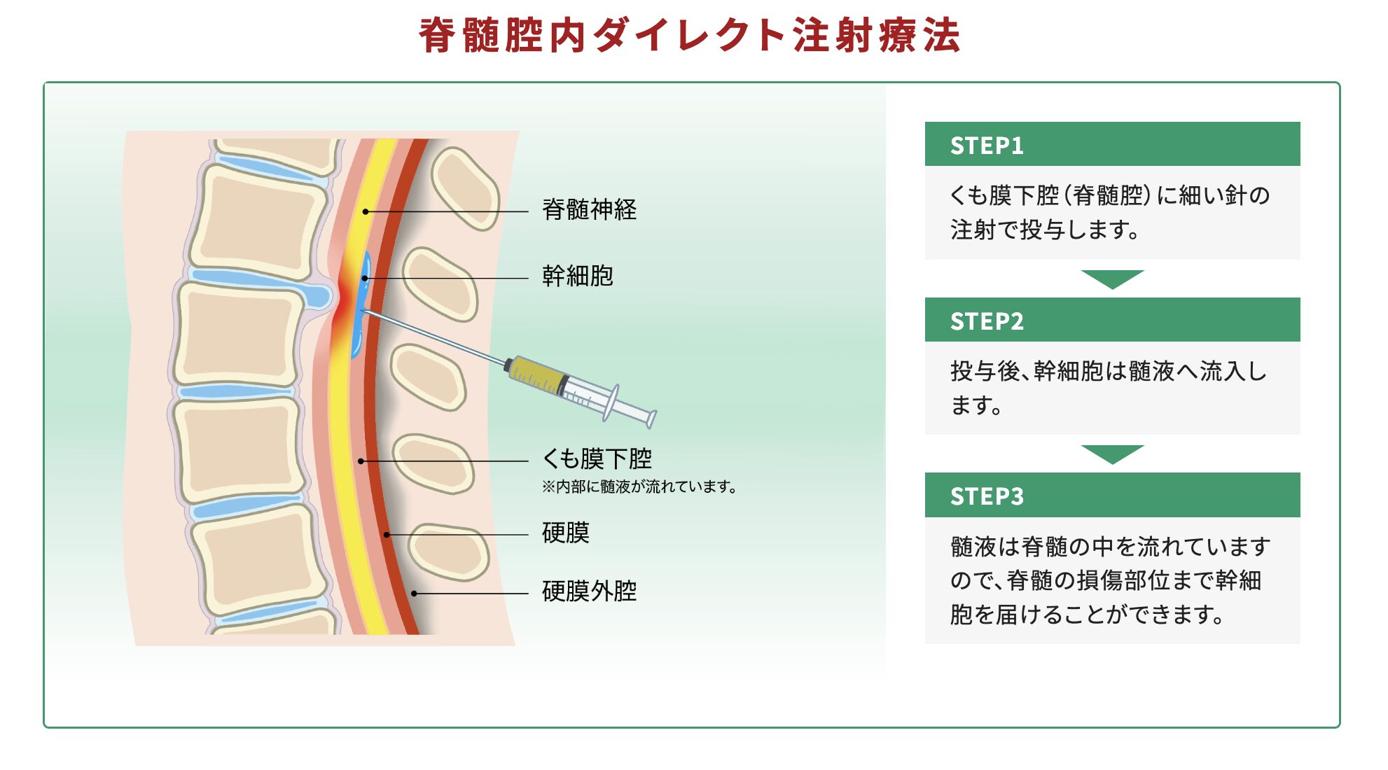 脊髄梗塞とは？突然の背中の痛みと両足麻痺が見逃せない理由