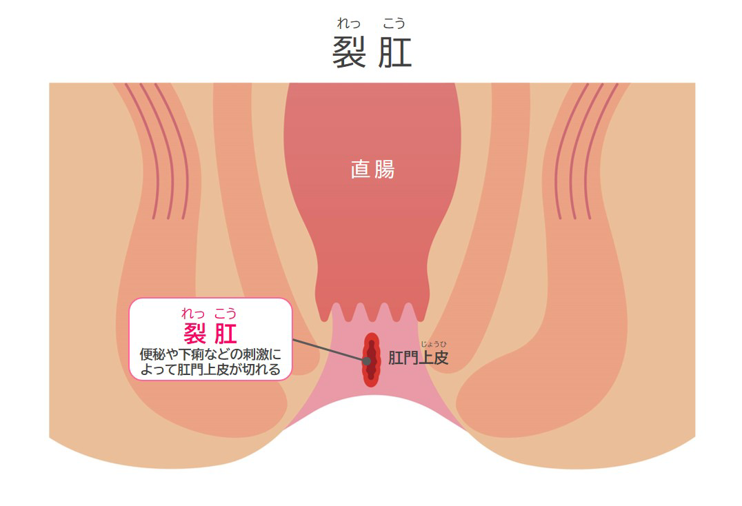 切れ痔の症状を見逃すな｜2026年最新の痛みのサインと正しい対処・再発予防の全知識