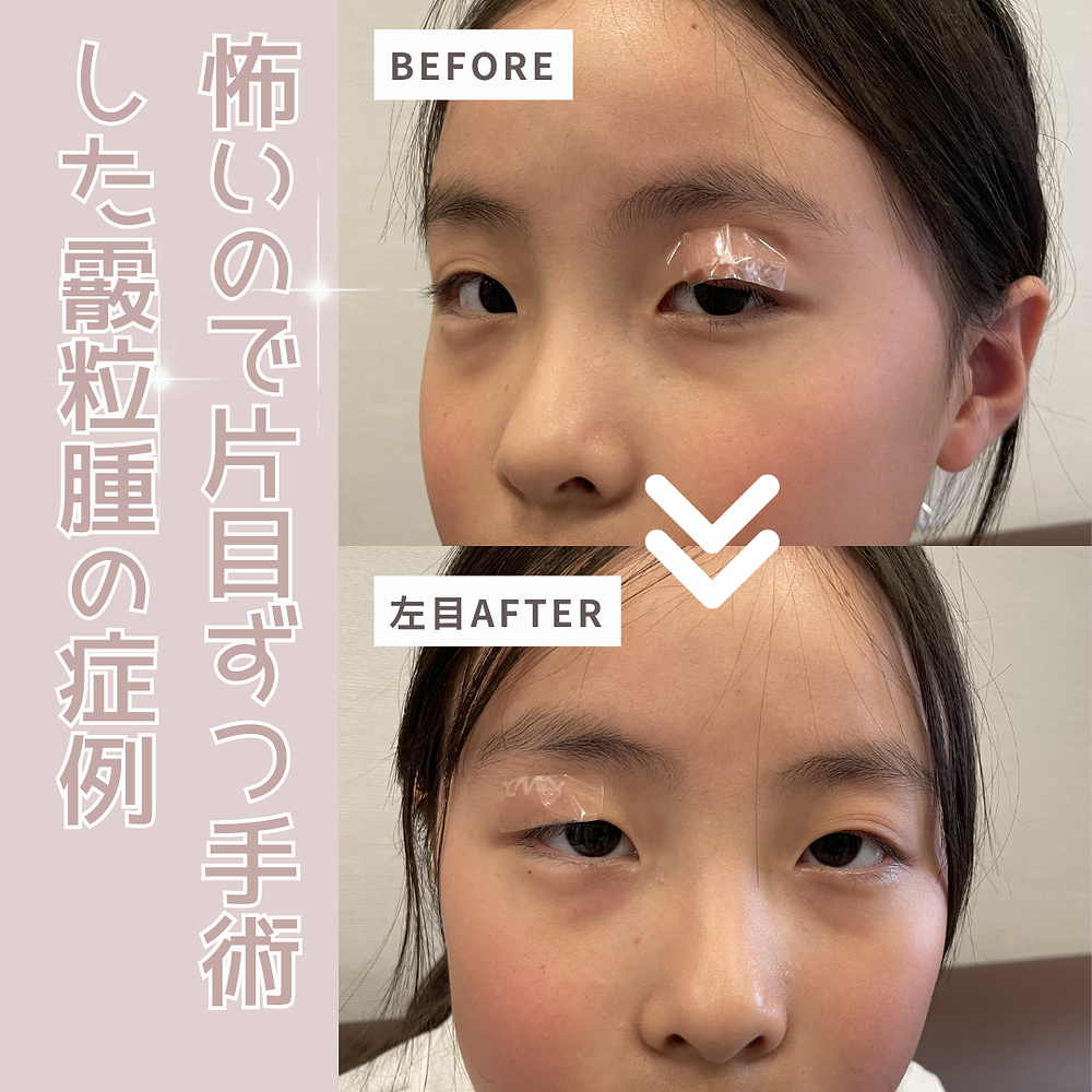 霰粒腫手術で「失敗」と感じる真相｜しこりや腫れが引かない理由と対処法