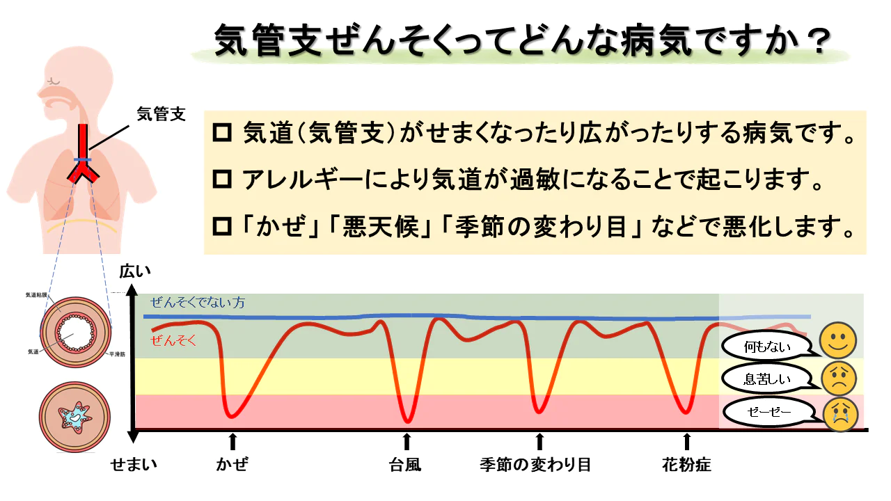 気管支喘息は本当に「治る」のか？寛解の定義と2026年最新治療の決定的真実