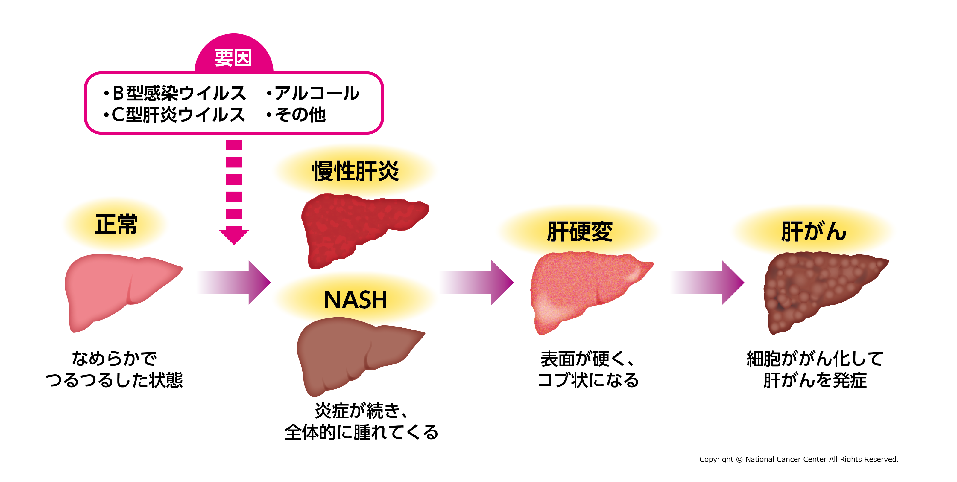 肝臓がんの初期症状と危険な前兆｜2026年最新治療と生存率を徹底解説