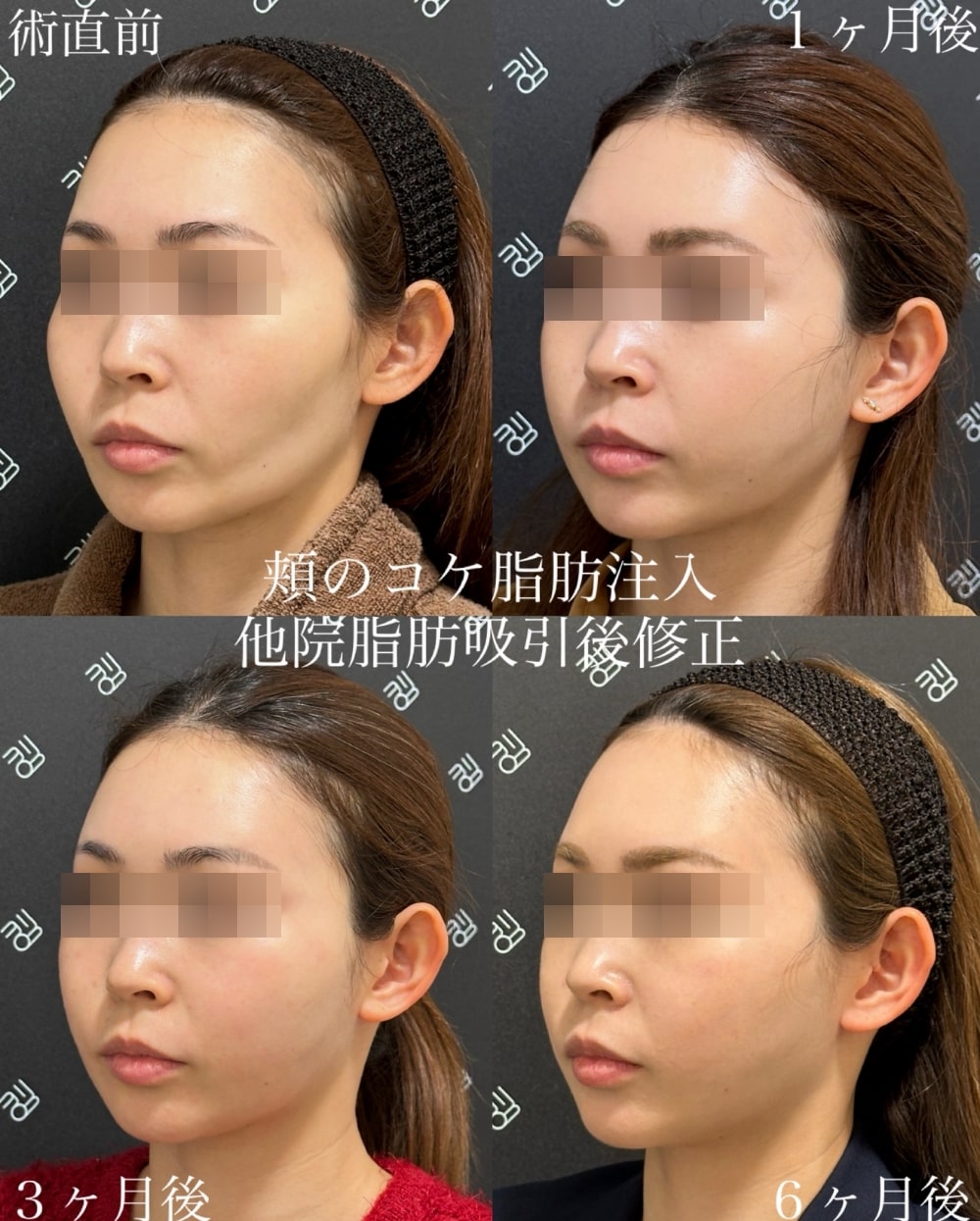 頬のこけ、老け見えの真因と2026年最新アプローチ｜医師が警鐘する“危険な自力ケア”と失敗しない改善ロードマップ