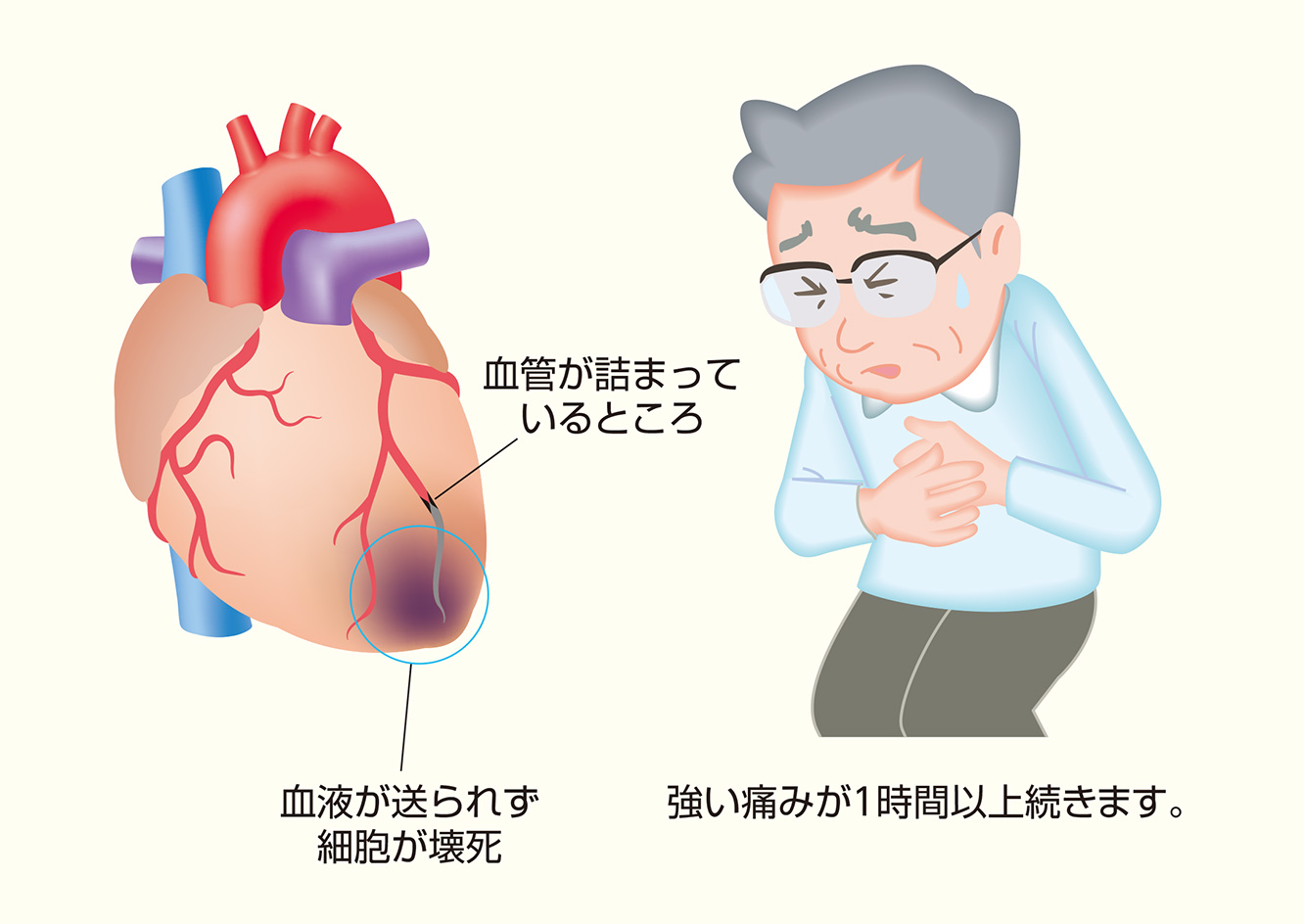 虚血性心疾患の前兆と初期症状を見抜く！狭心症と心筋梗塞の違いと最新予防