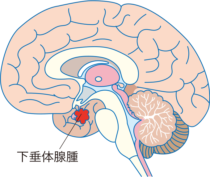 ガンバレルーヤよしこの闘病劇が投じた一石——「下垂体腺腫」の真実と、私たちが知るべき身体の警告サイン