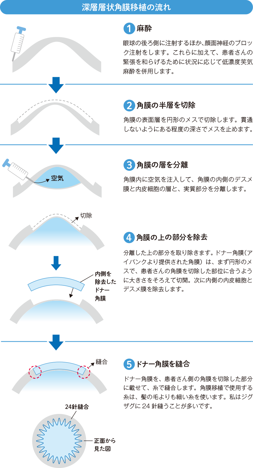 円錐角膜の治療最前線2026！進行停止から最新レンズまで徹底解説