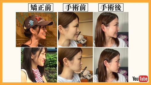 【必見】 顎 変形 症 手術 芸能人 インスタライブ最新動画 #941