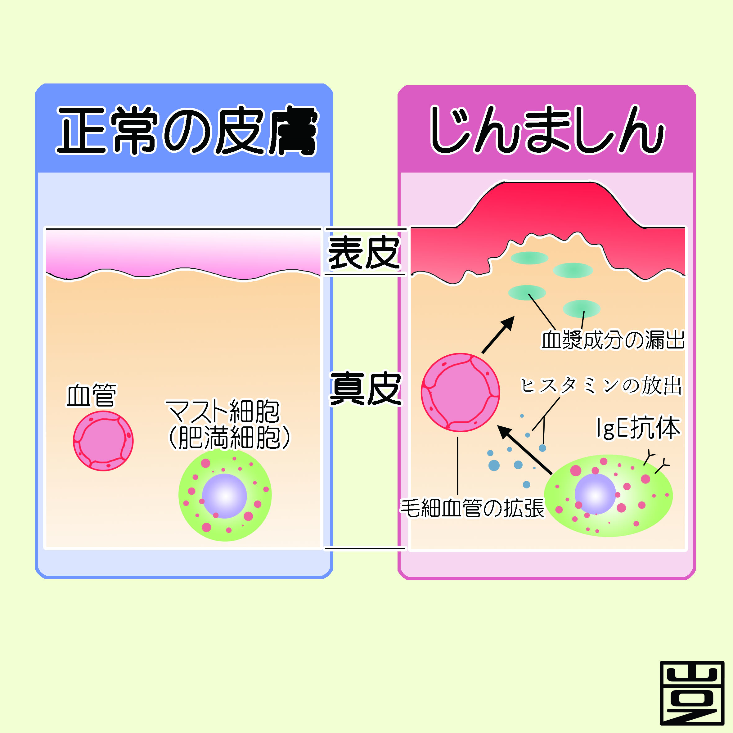 突然の蕁麻疹はなぜ起きる？原因の7割が不明とされる真相と即効対処法