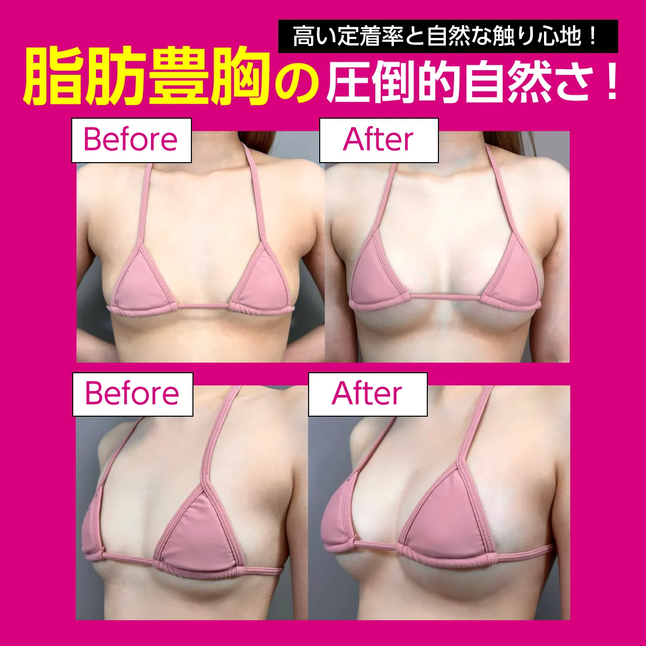 豊胸モニターの真相｜顔出しなしの費用相場と審査基準・失敗を防ぐ全知識
