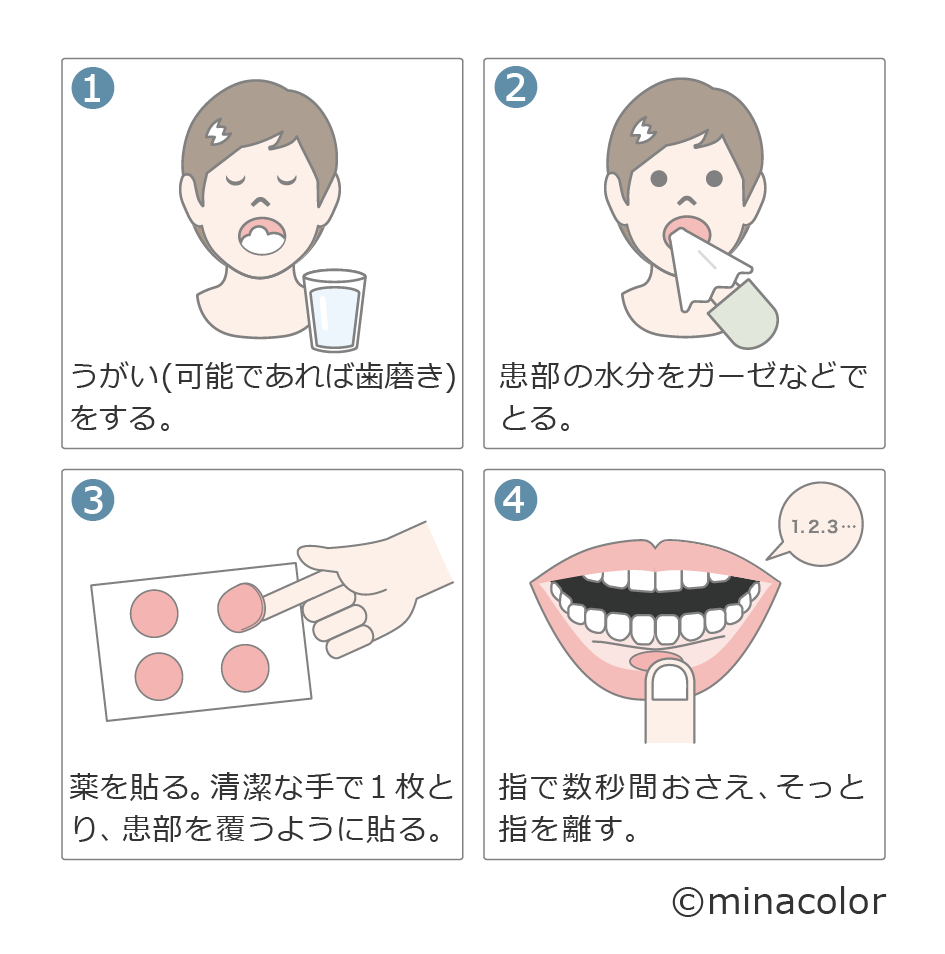 口内炎を即効で治す方法とは？一晩で痛みを鎮める裏ワザと市販薬の選び方