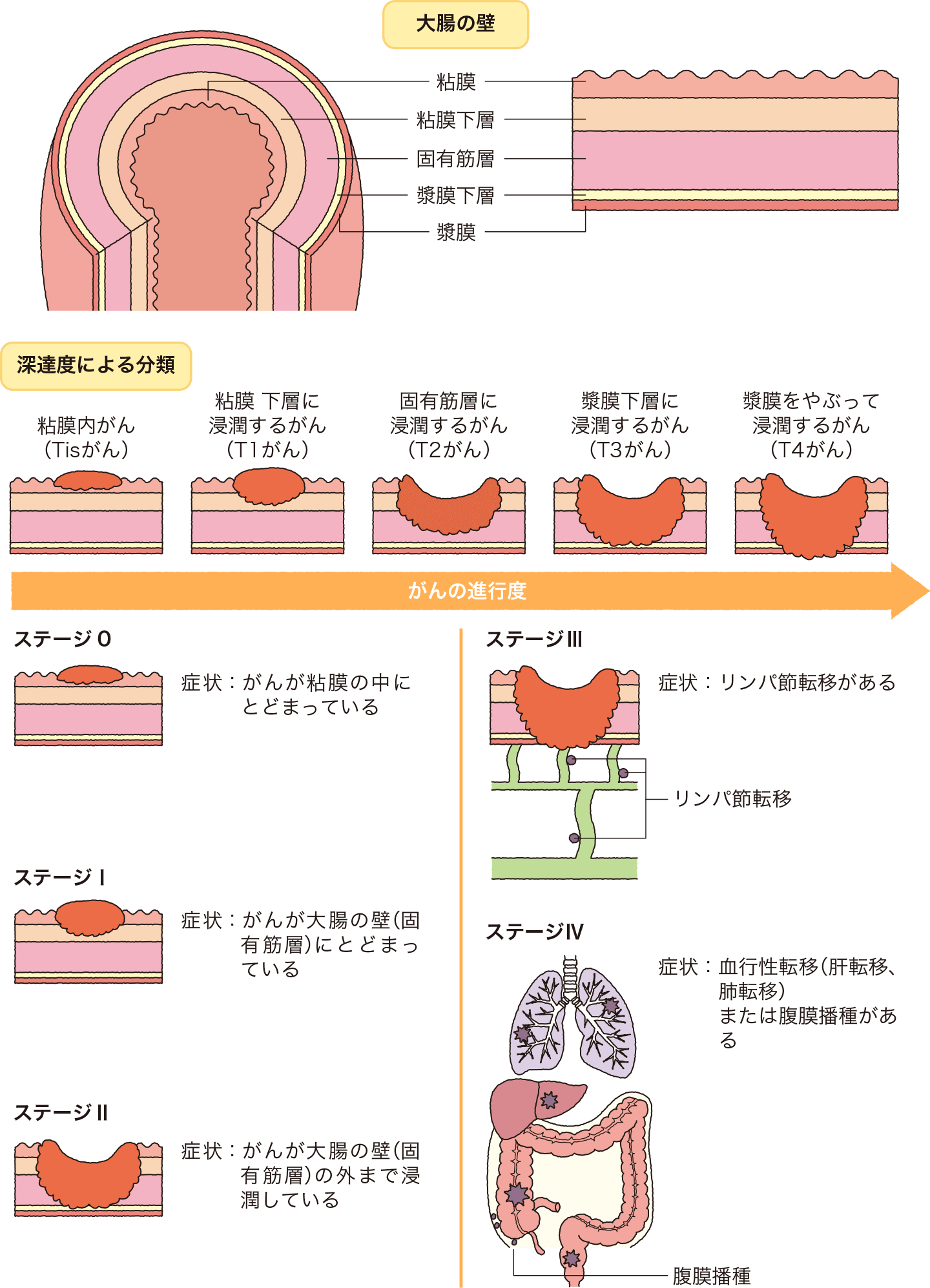 大腸がんは早期なら9割完治？無症状の罠と便潜血検査の真実