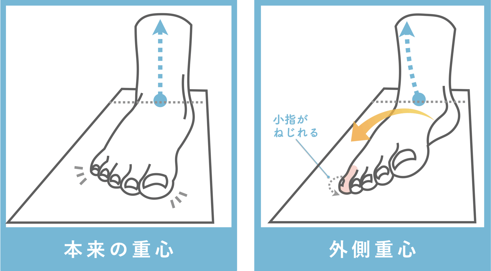 足の小指が倒れる寝指の治し方｜原因と自宅ケア・改善策を徹底解説