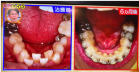 【動画まとめ】 さらば 森田 歯並び 最新熱愛噂まとめ #844