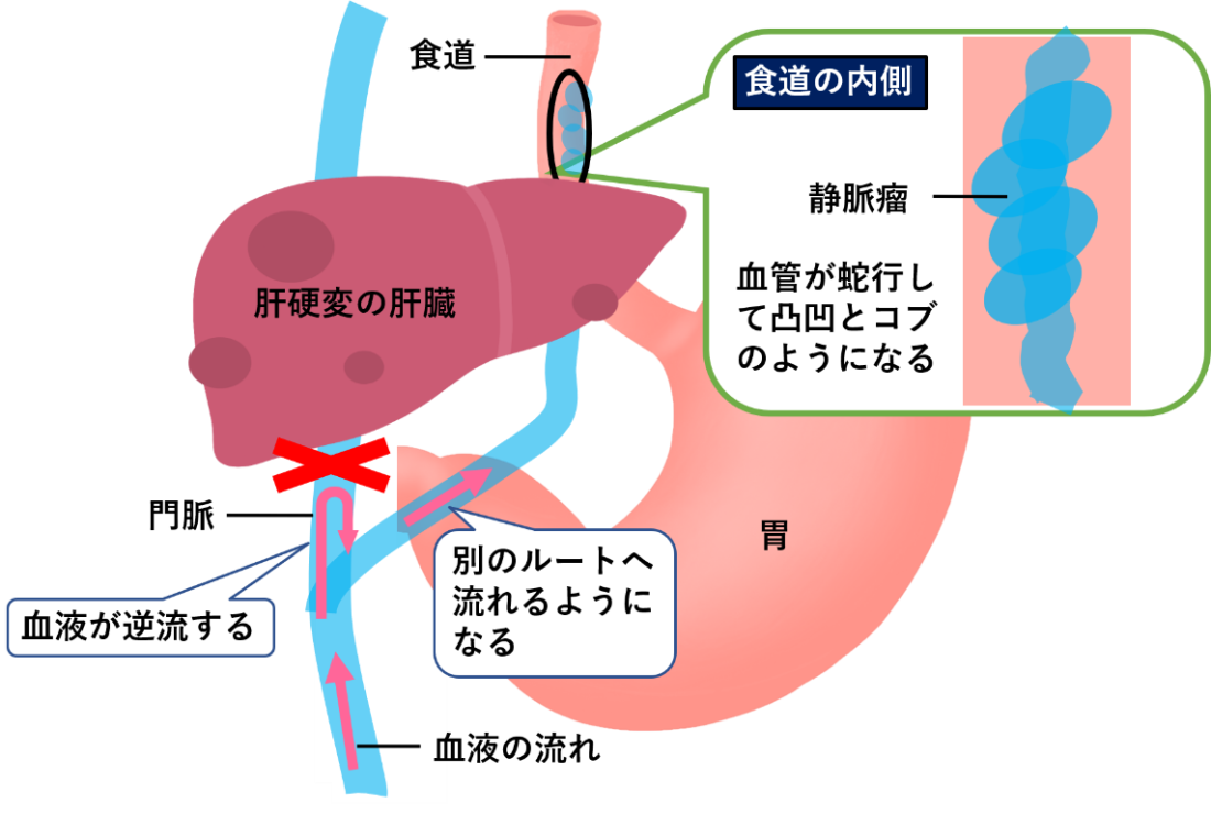 肝硬変が招く食道静脈瘤の真実｜破裂の前兆と最新治療・余命を徹底解説